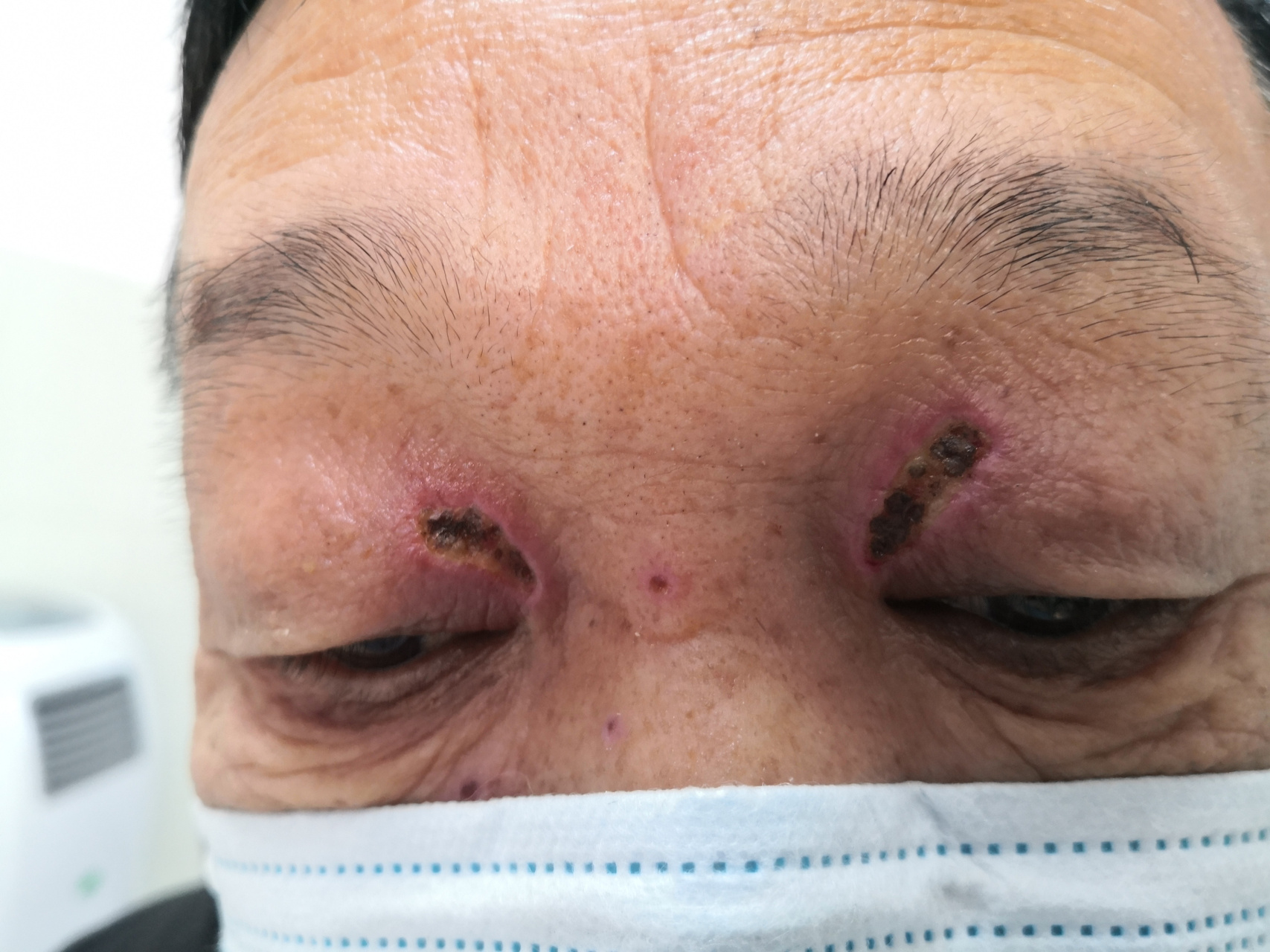 睑黄疣激光治疗后的恢复期症状.#睑黄疣