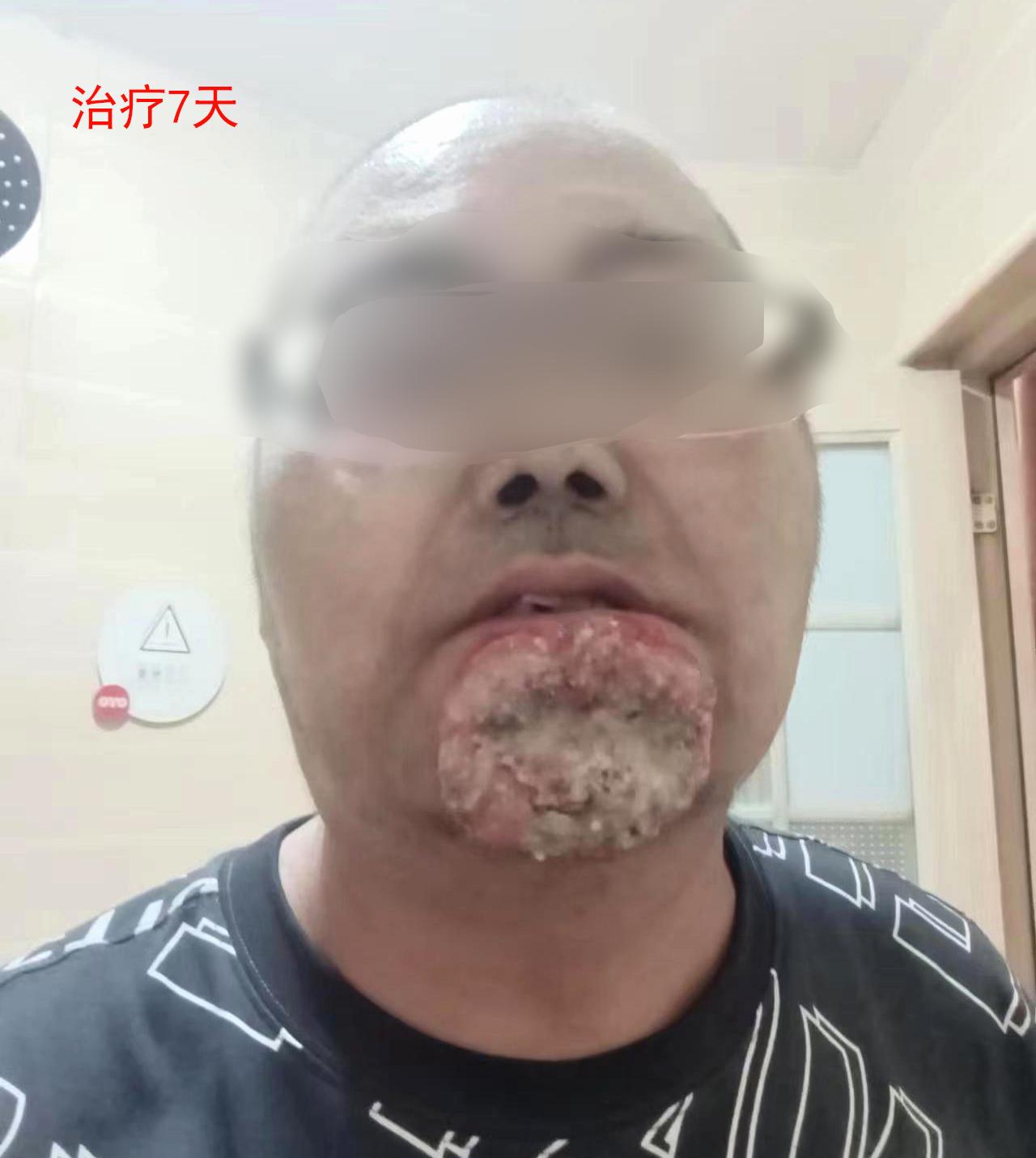 患者男性42岁下巴肿瘤巨大破溃感染诊断口腔黏膜恶性肿瘤