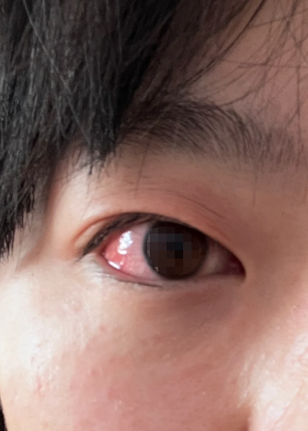 这种情况通常和用眼过度,老年人血管硬化或者高血压有关
