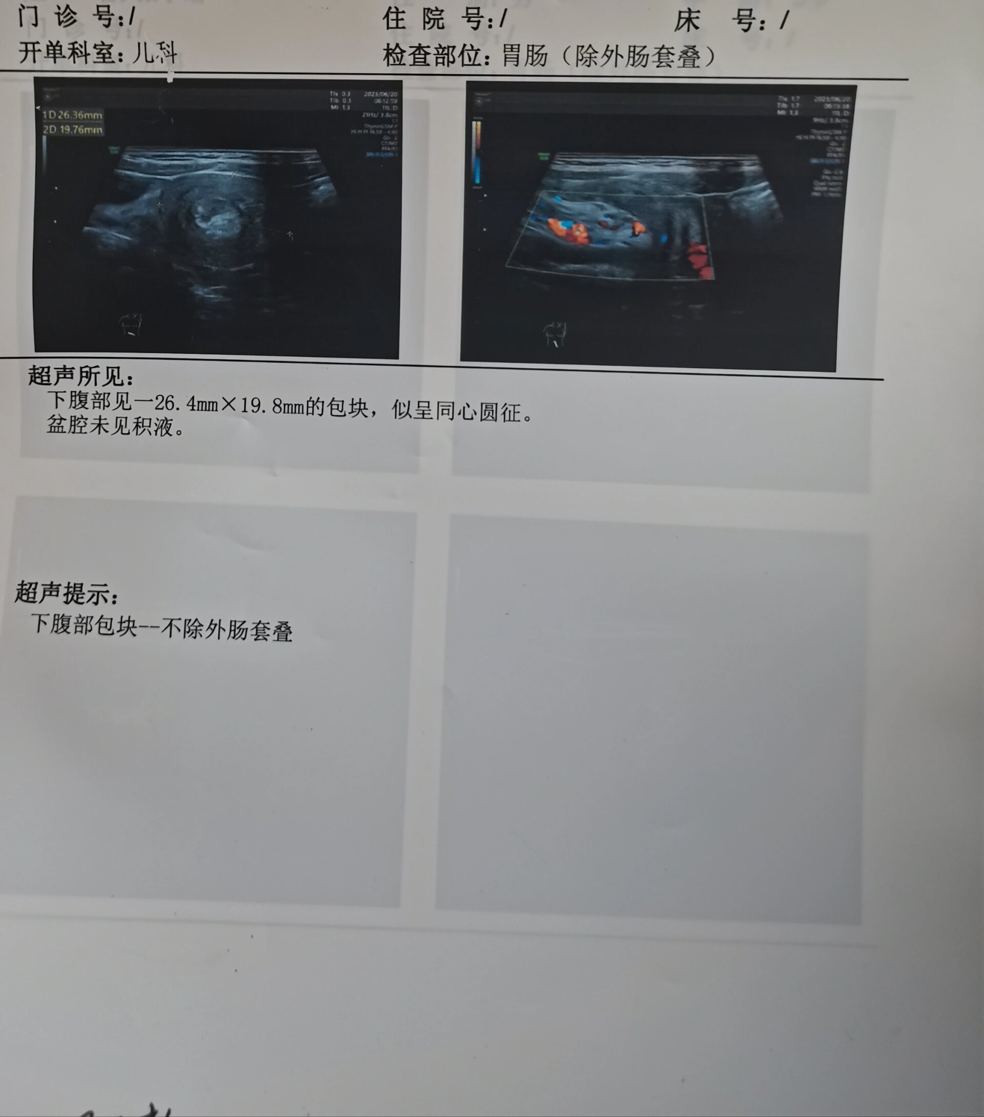 6岁肠套叠解套 早上五点多突然说肚子疼,肚脐那里疼.