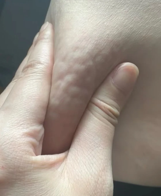 人身上为什么长脂肪瘤