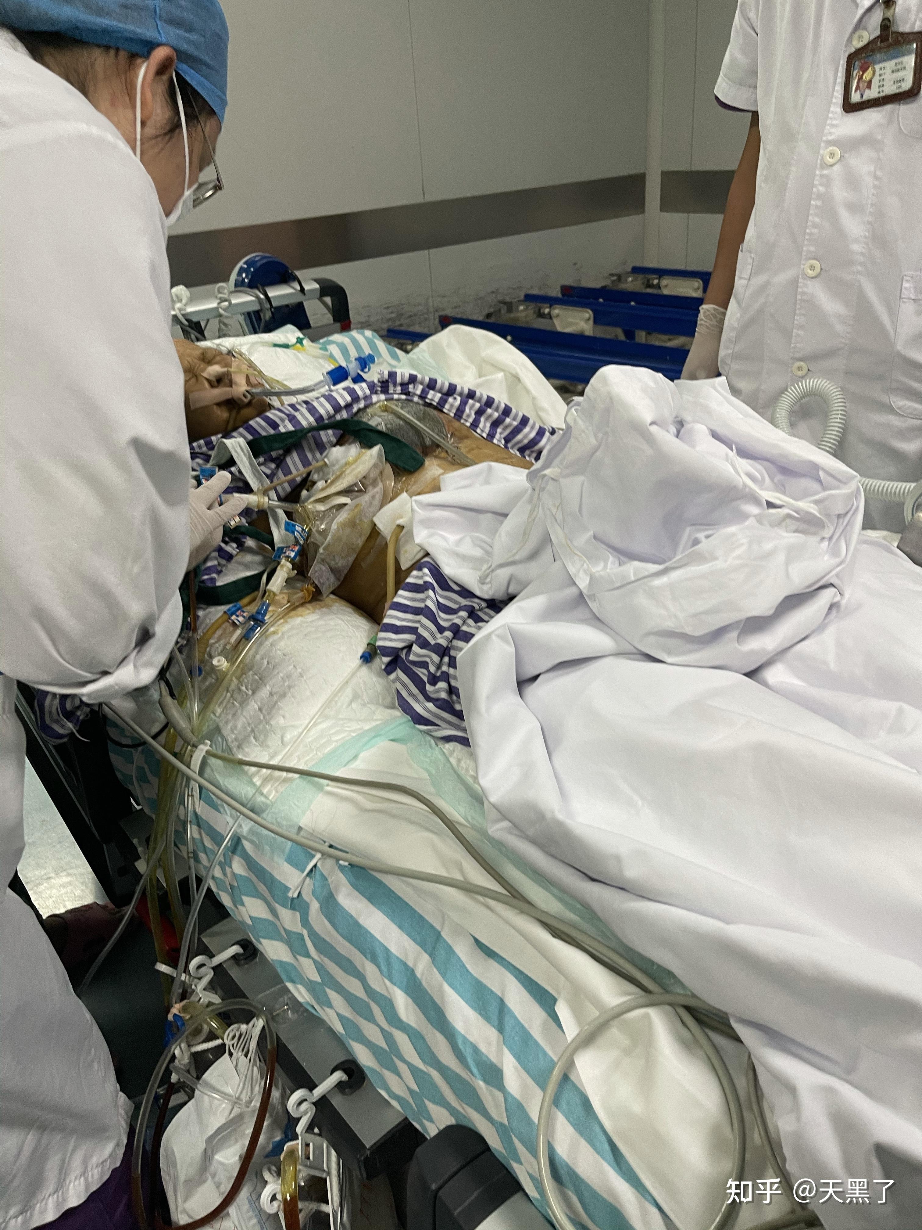 广东医学院附属第二医院要命的ercp胆管微创取石手术