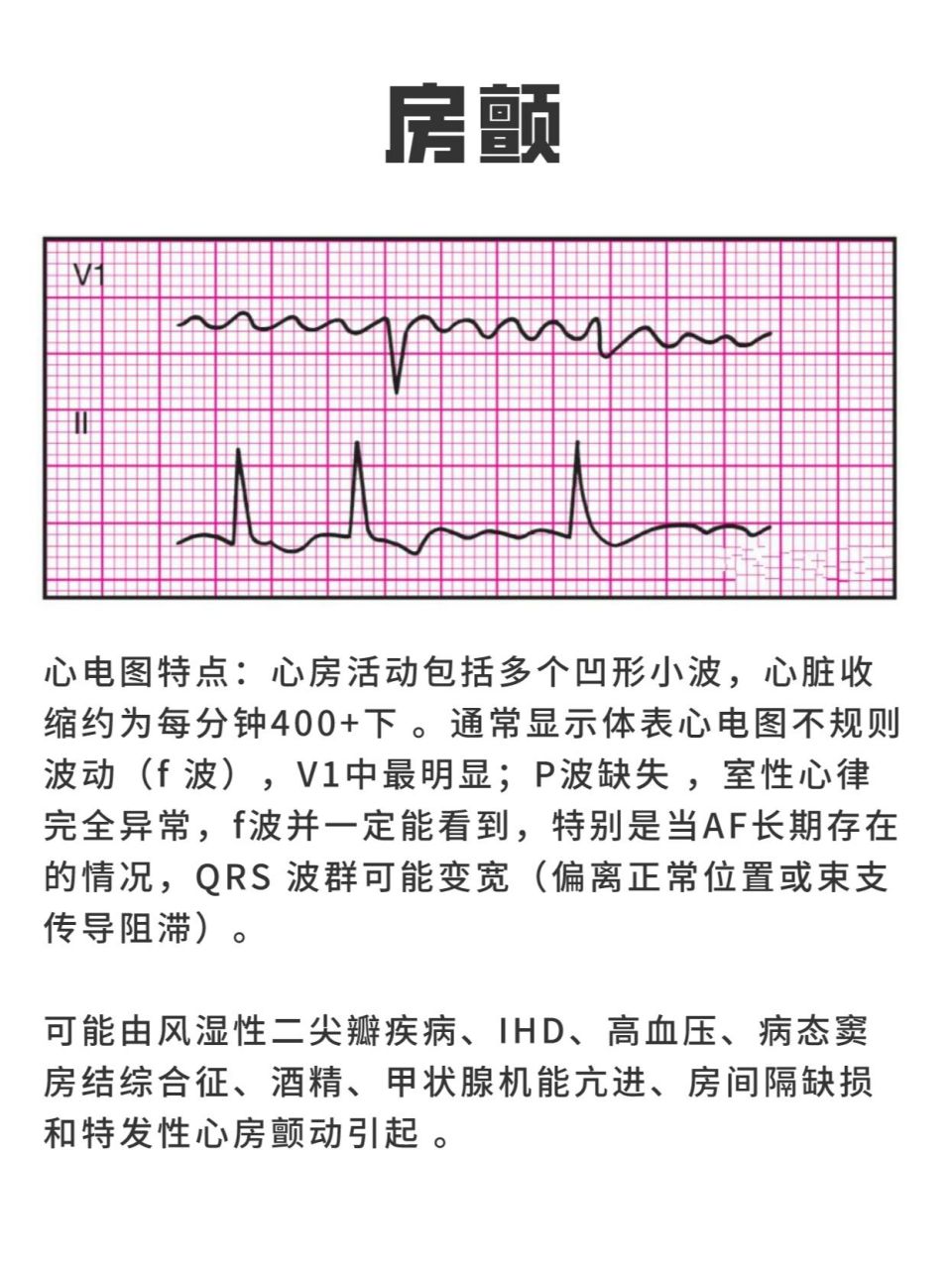 9614種異常心電圖的波形特點(一) 對於醫考生來說,準確讀懂心電圖是