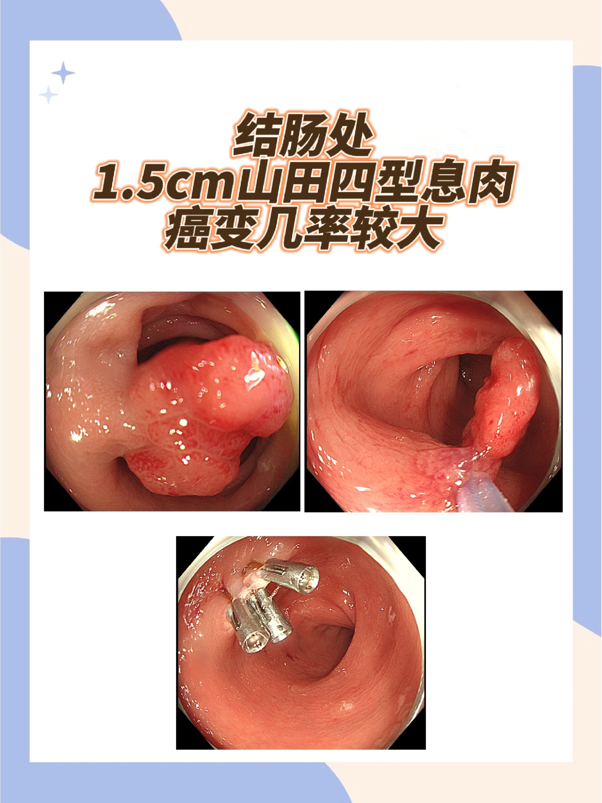 肛门息肉严重吗图片