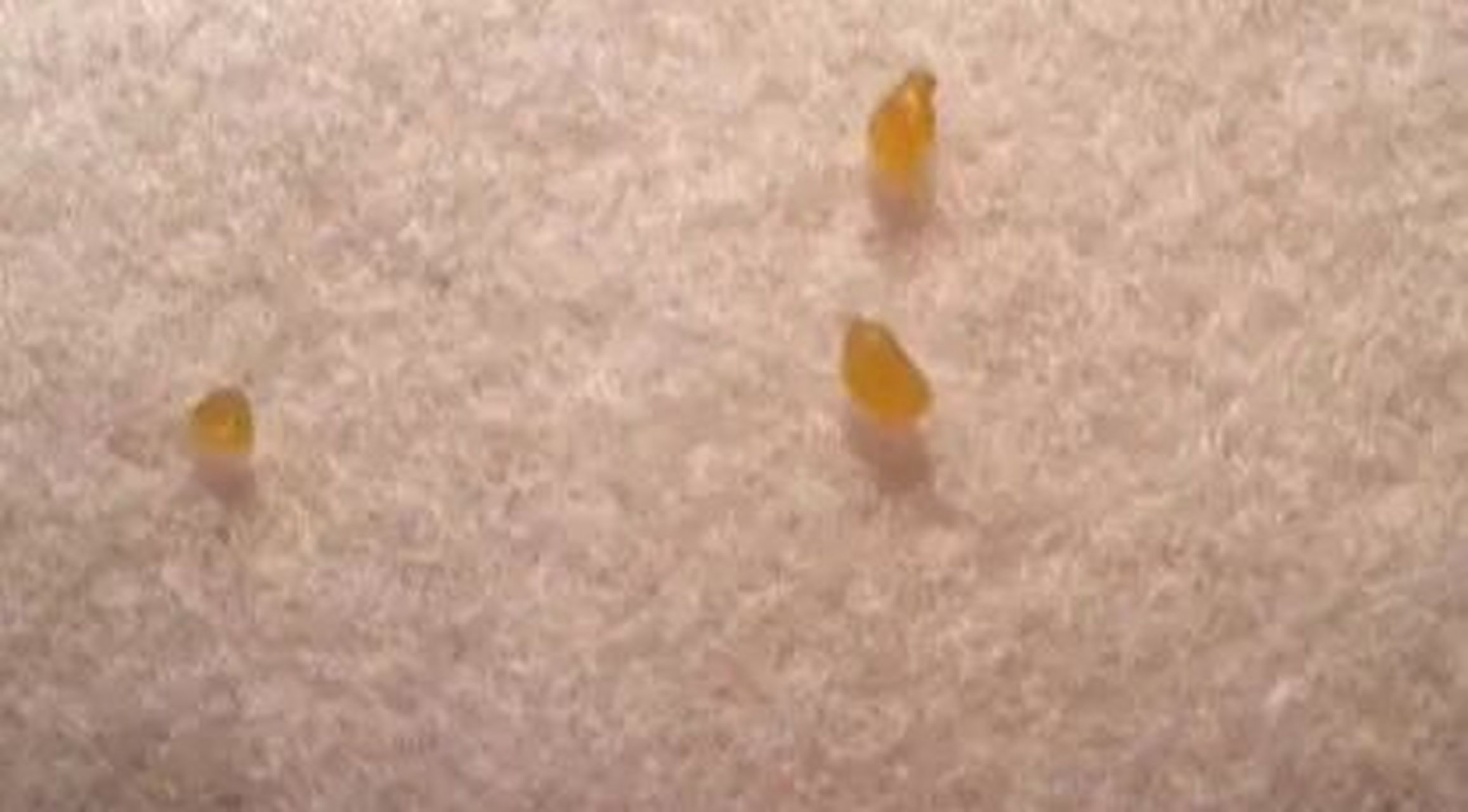 头皮上掉下来的黄色的小颗粒,这个是什么?