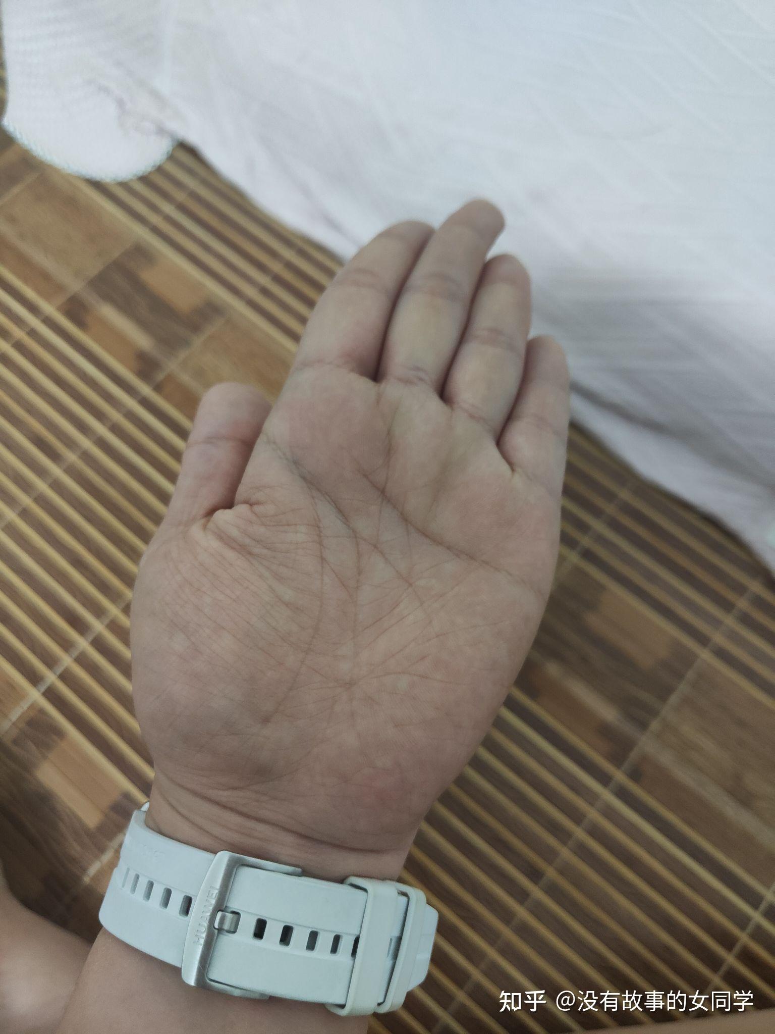 回答一下骨折后尺神经重度损伤现在我的情况