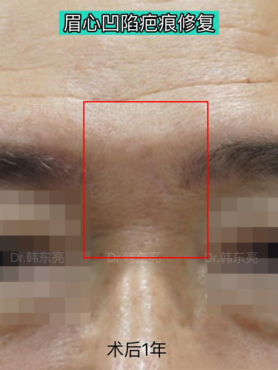 【眉心凹陷疤痕修复案例】 患者眉心中间的凹陷疤痕,之前本想做激光
