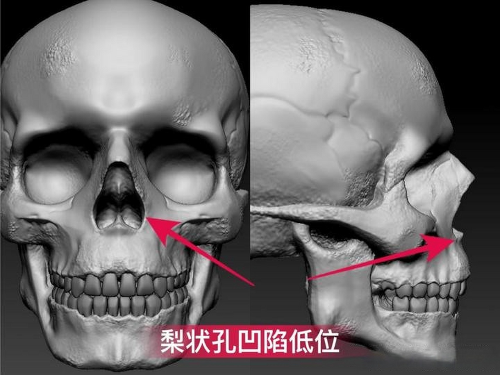 梨状孔解剖图图片