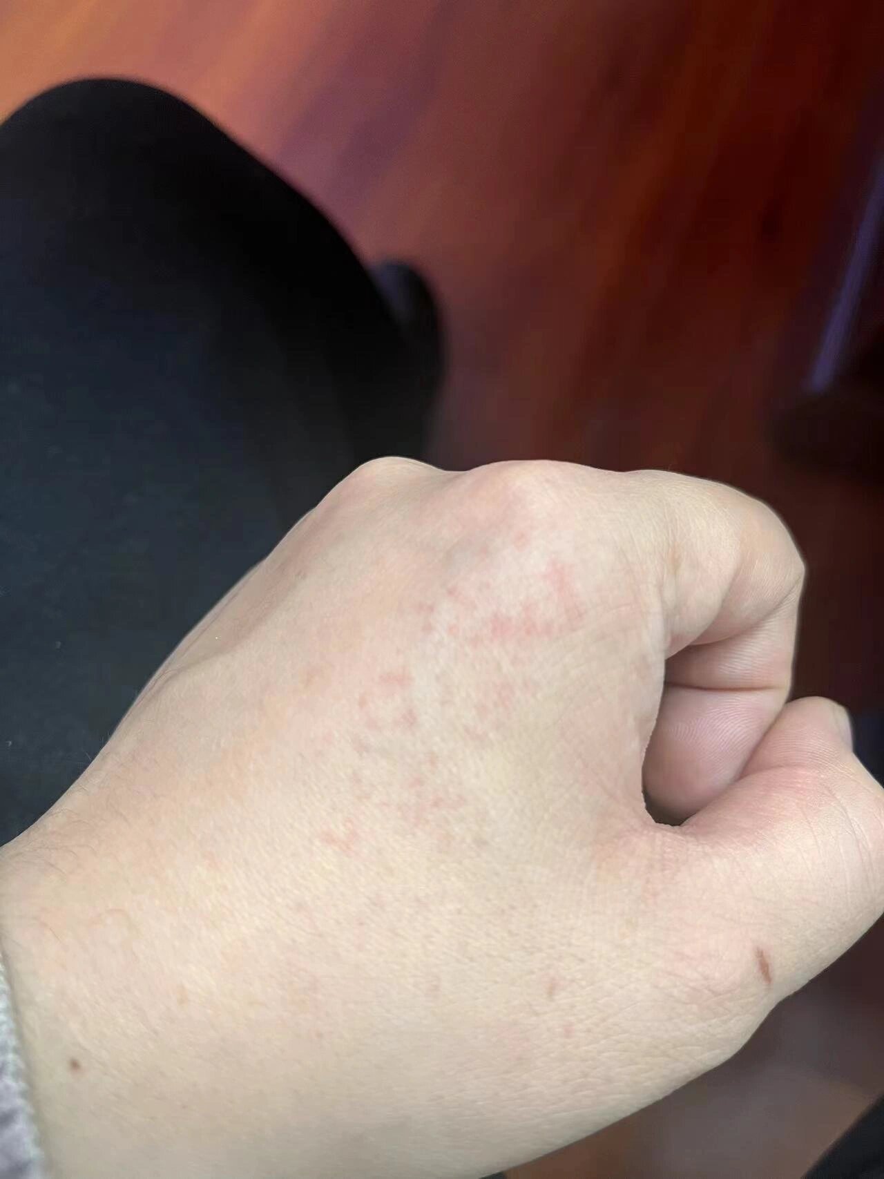 手背上有小红点 手背上偶尔会出现皮下小红点,摸着手背皮肤没异样,小