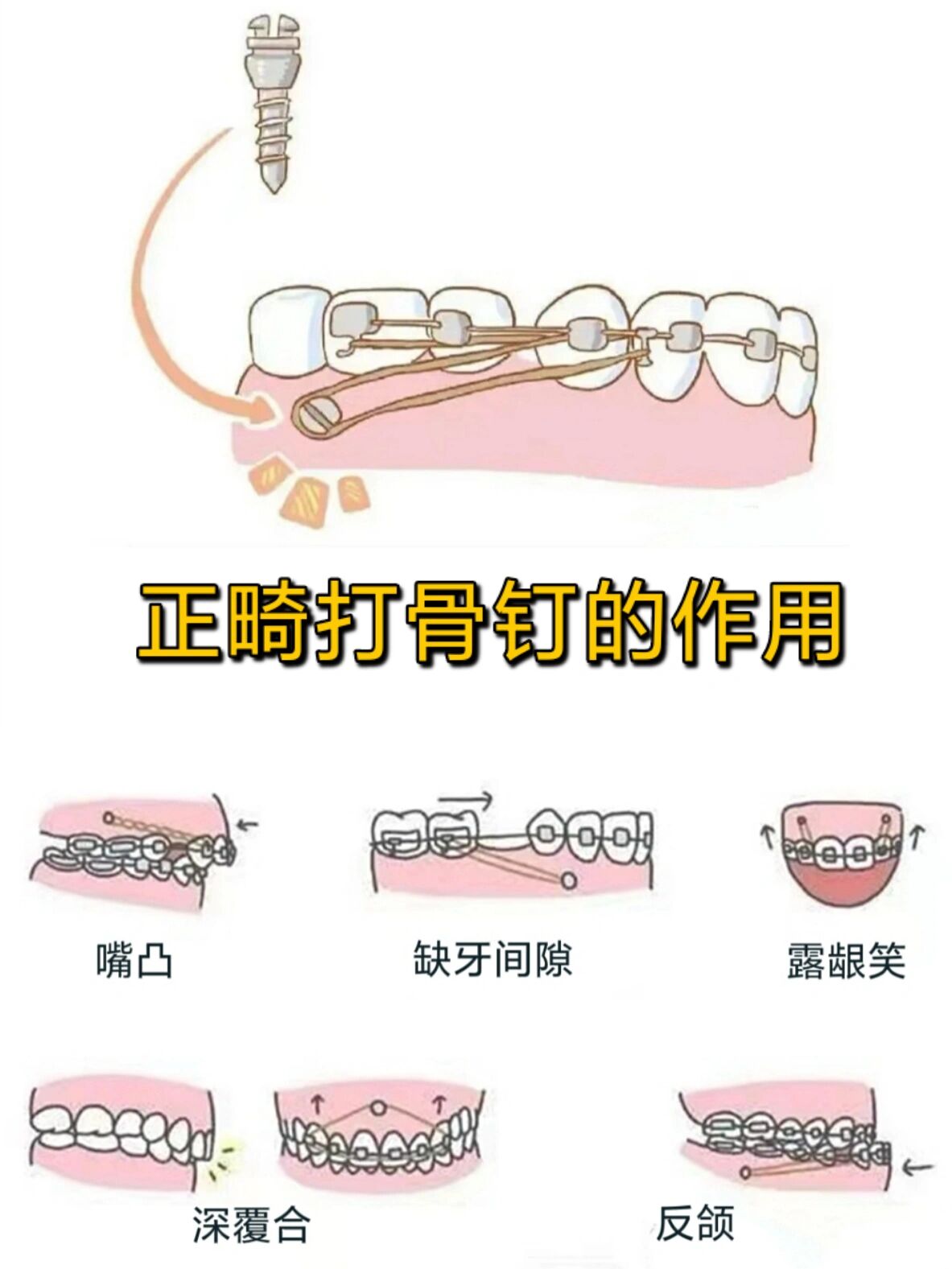 正畸打骨钉图片图片