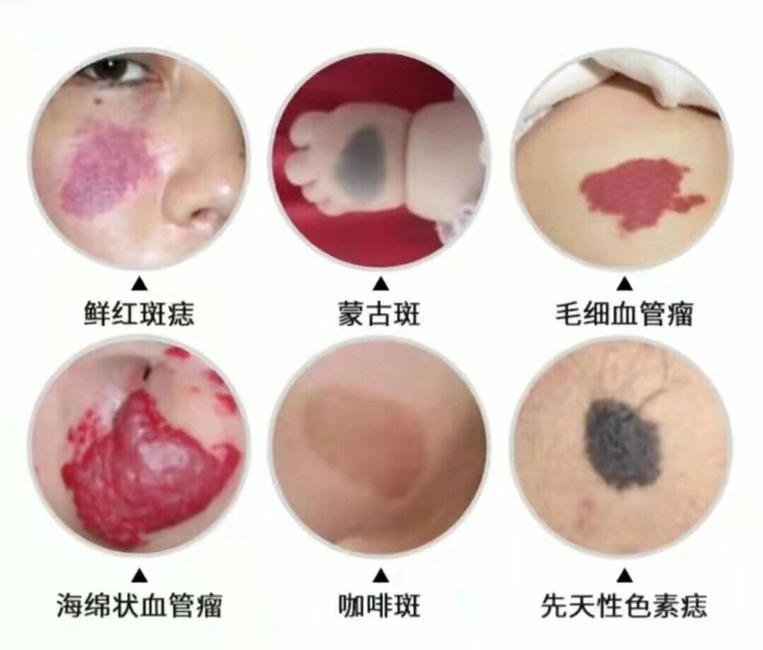 绝大多数痣都不会癌变,所以通常情况下它们均是无害,根本不需要点掉.