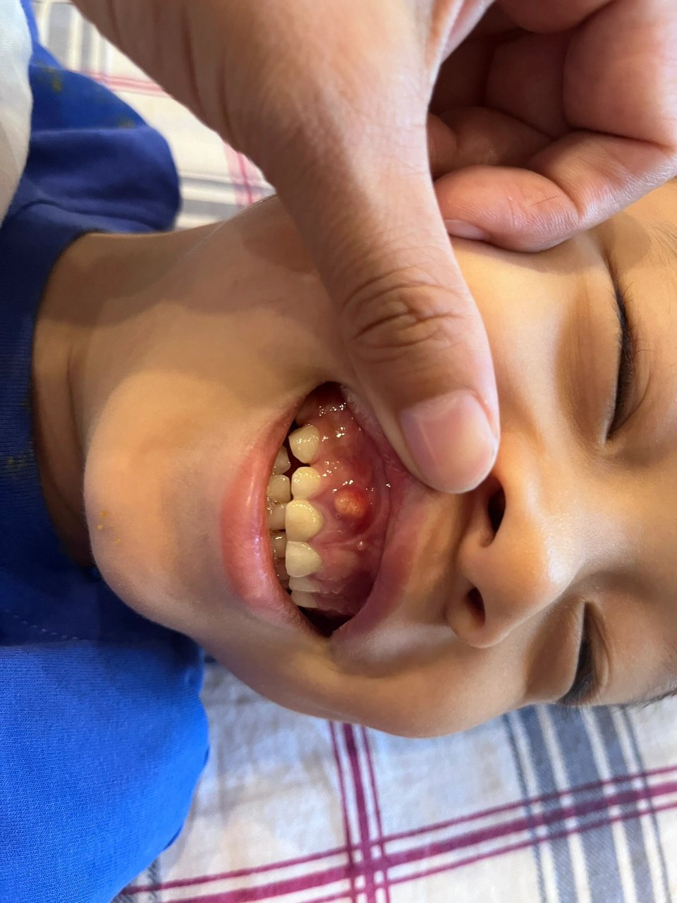 孩子牙龈上面长了一个包 牙龈上面长了这个,有段时间没有了,现在又