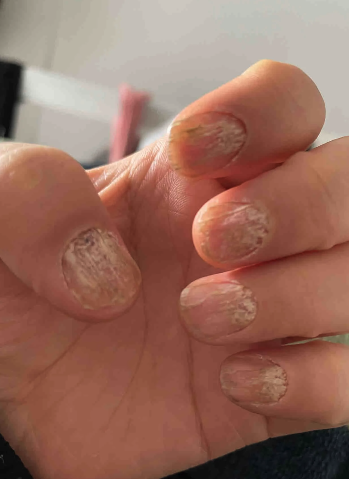 感染性甲病最常见的是真菌感染,比如灰指甲