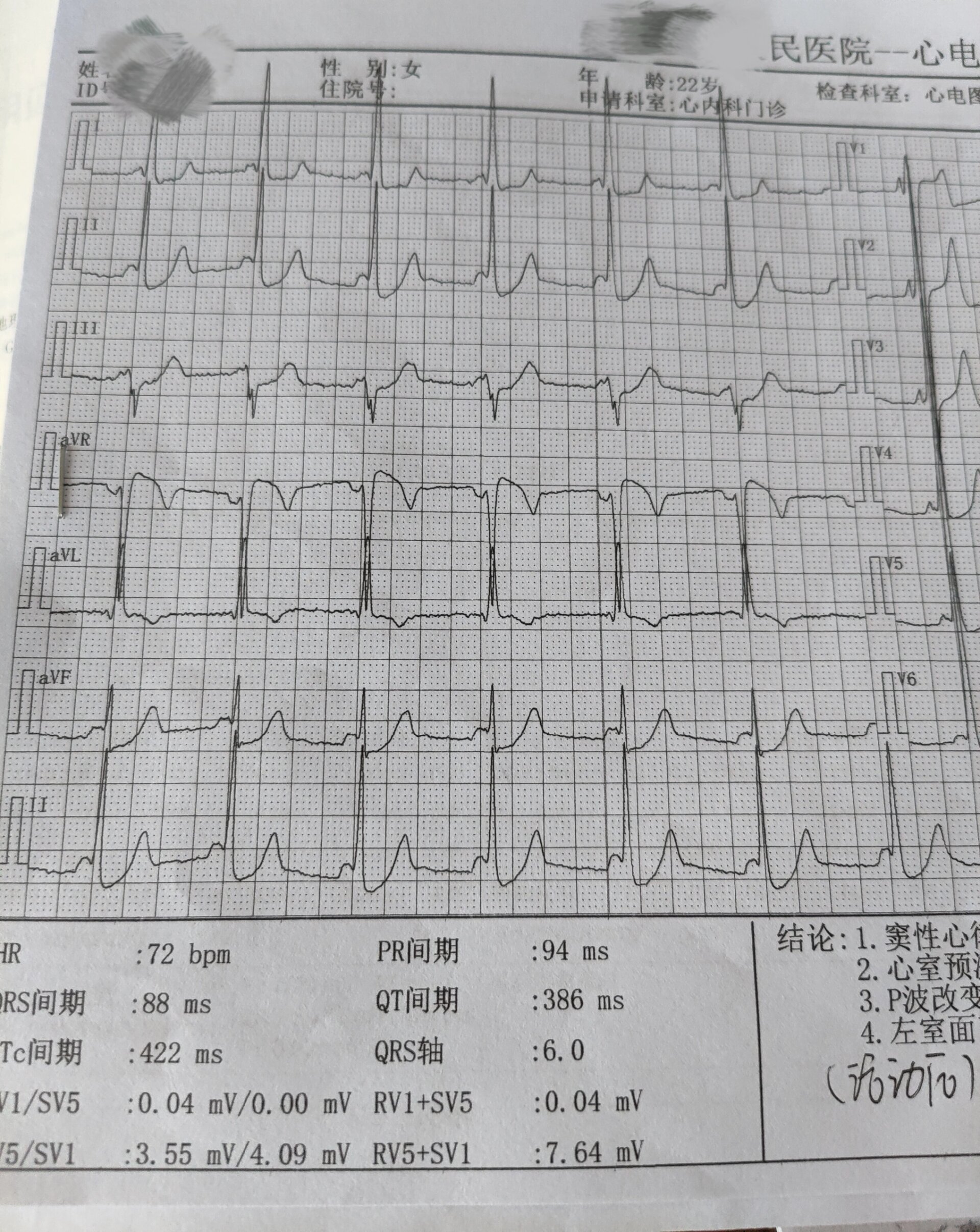 心室预激心电图图片
