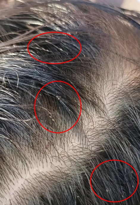 头上长虱子没有快速消除的办法,必须按科学方法处理