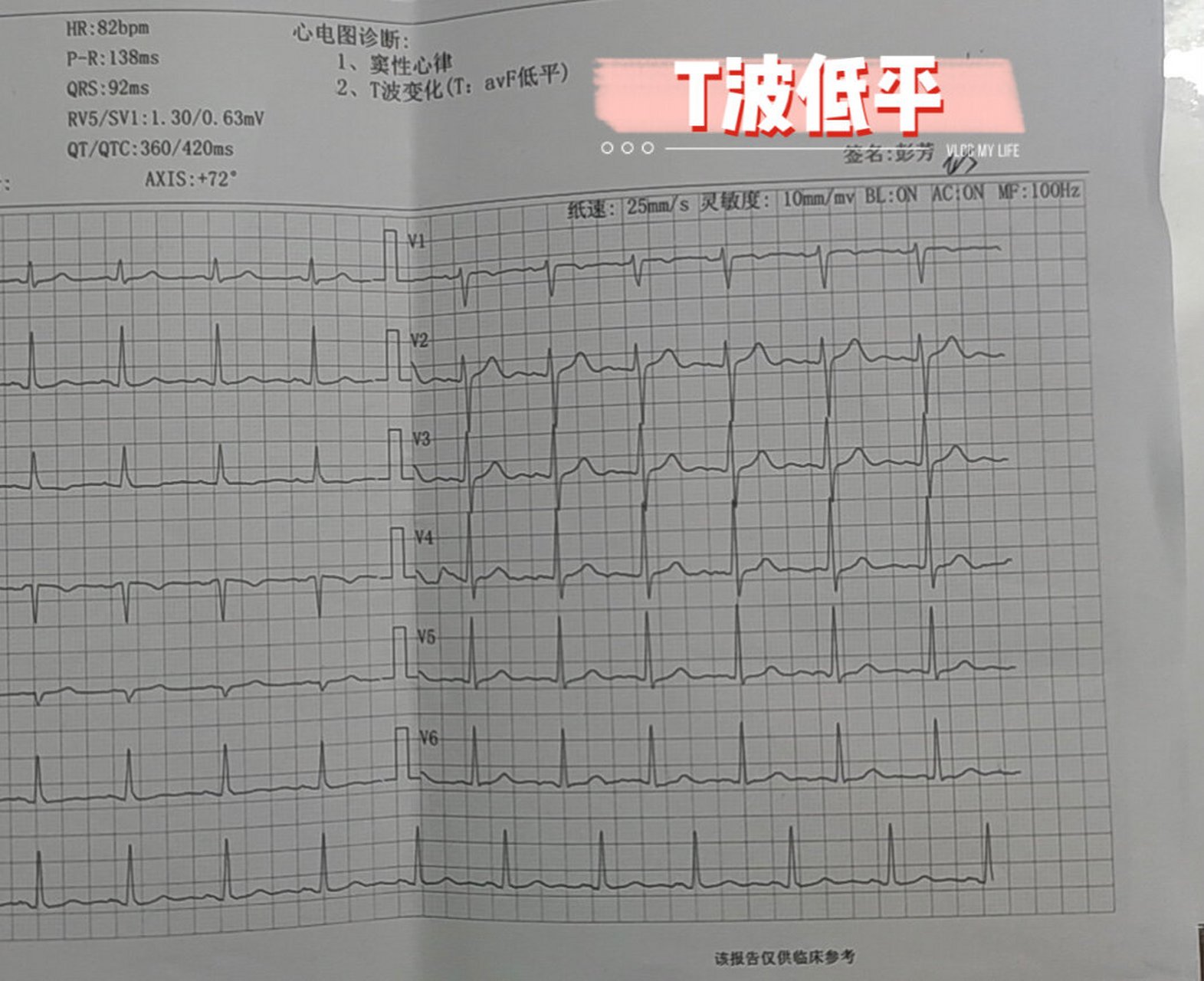 t波低平心电图图片