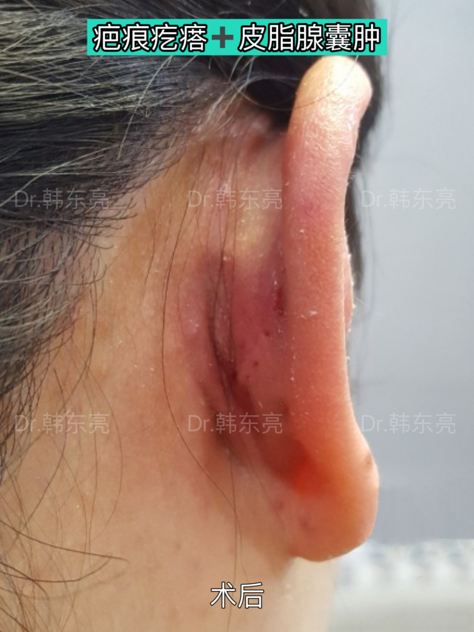 外耳道皮脂腺囊肿图片