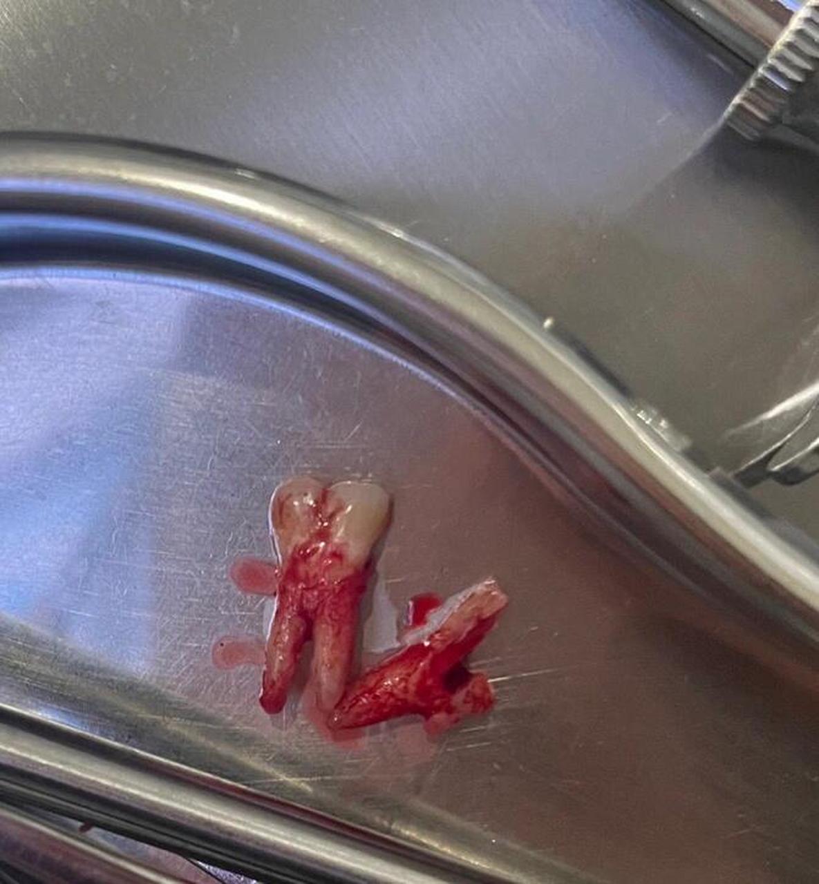 牙医说拔 牙齿裂了,第二幅图是裂下来的那一小块,真的就不能补了吗?