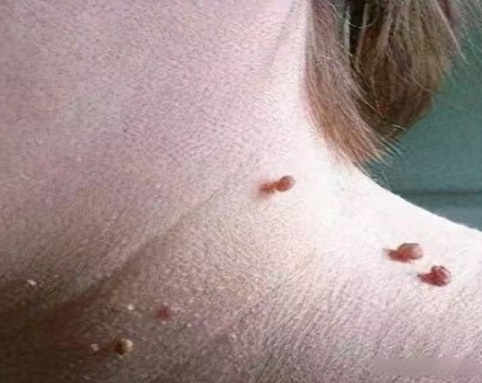 人乳头瘤病毒图片初期图片