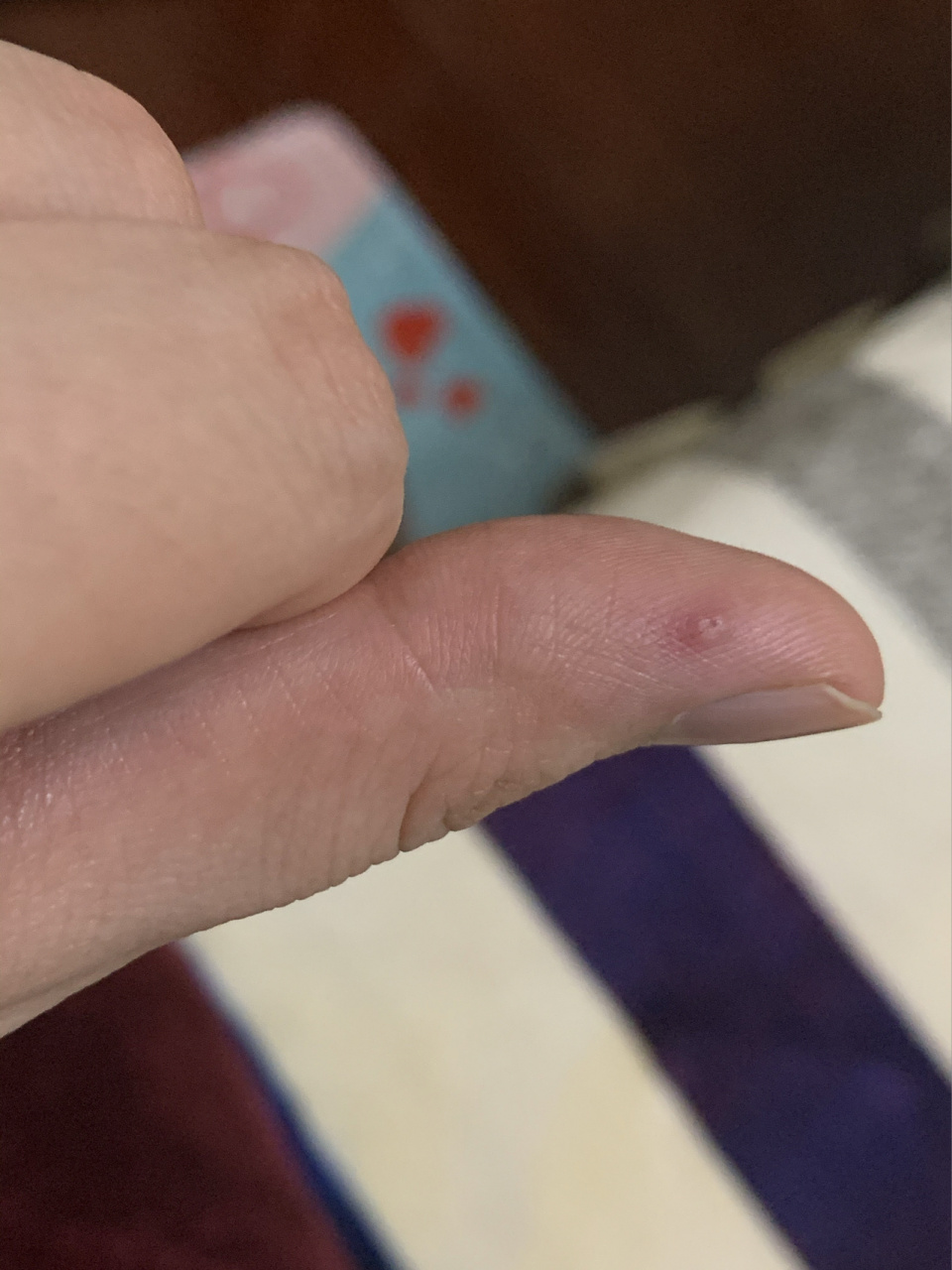 手上有小红点,不痒也不怎么疼 突然有一天,看到手指上有一个红点,长在