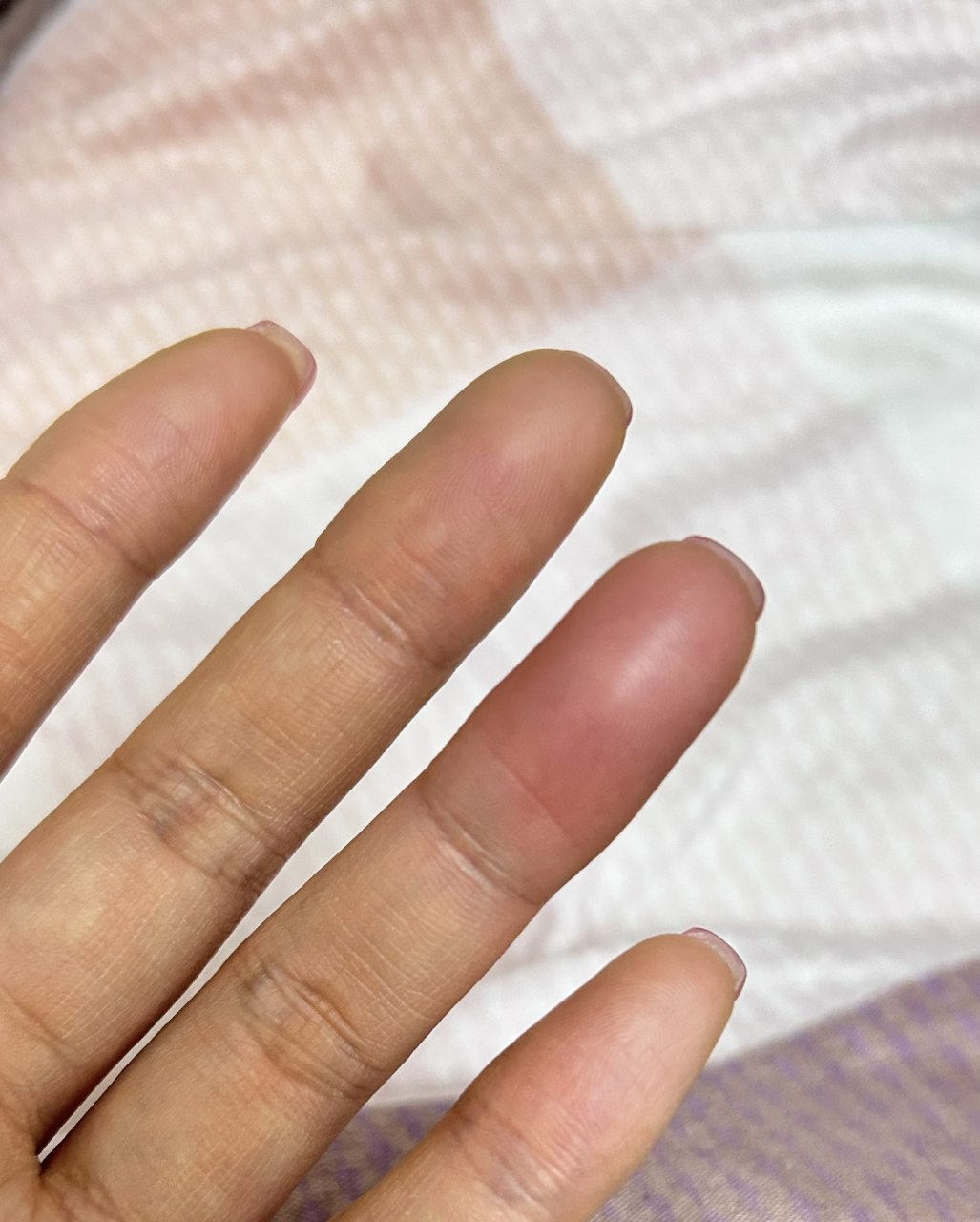 突然手指肿胀 吃着东西,突然就觉得左手无名指突然不舒服,过了几分钟