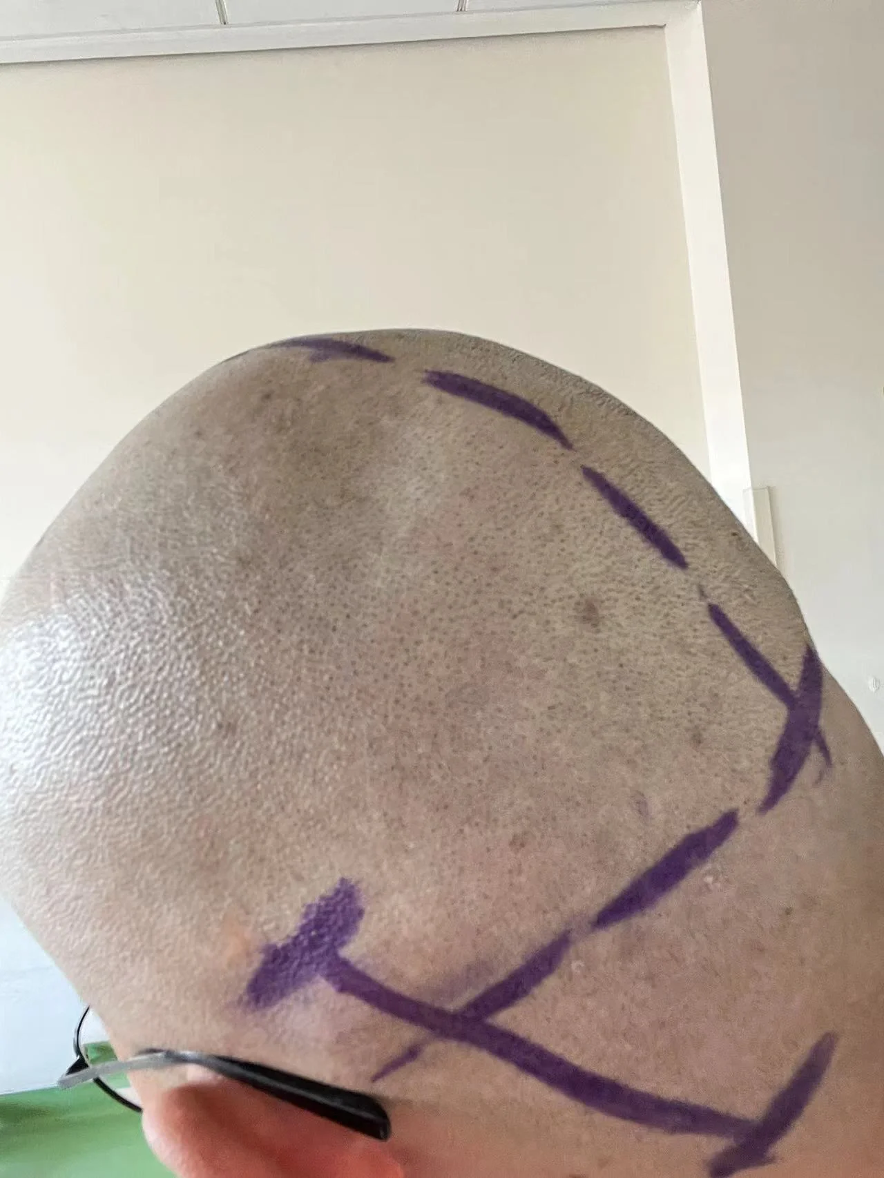 听神经瘤,不可怕!不要怕!