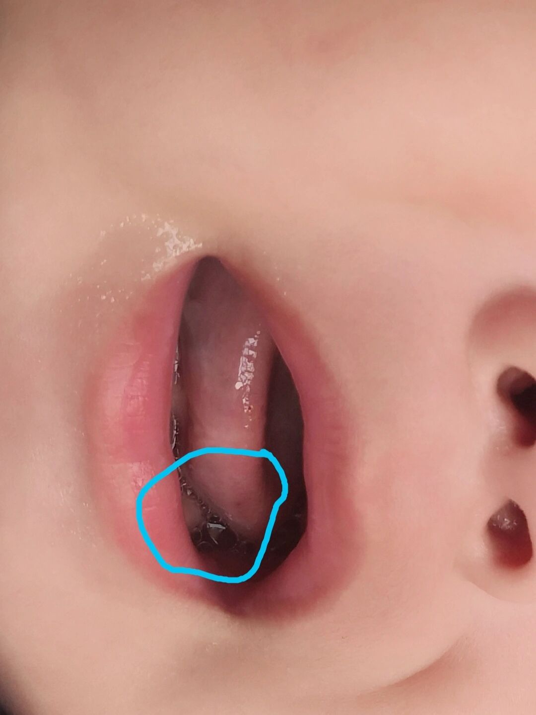 宝宝舌尖红 这是上火?已经开始给他适当多喝水,观察看看什么时候能好