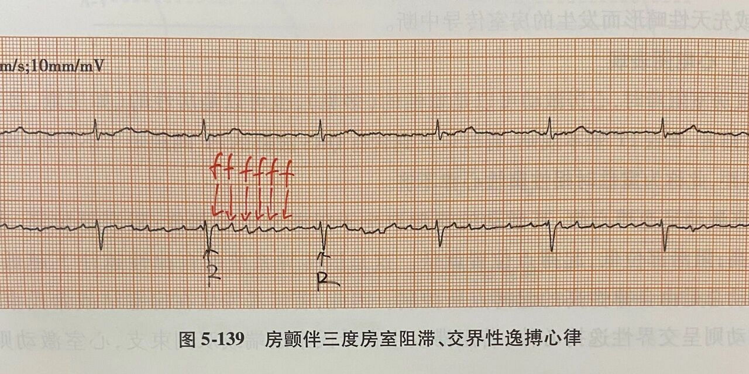 简易心电图(房颤,房扑伴三度房室传导阻滞) 7815房颤伴三度:166