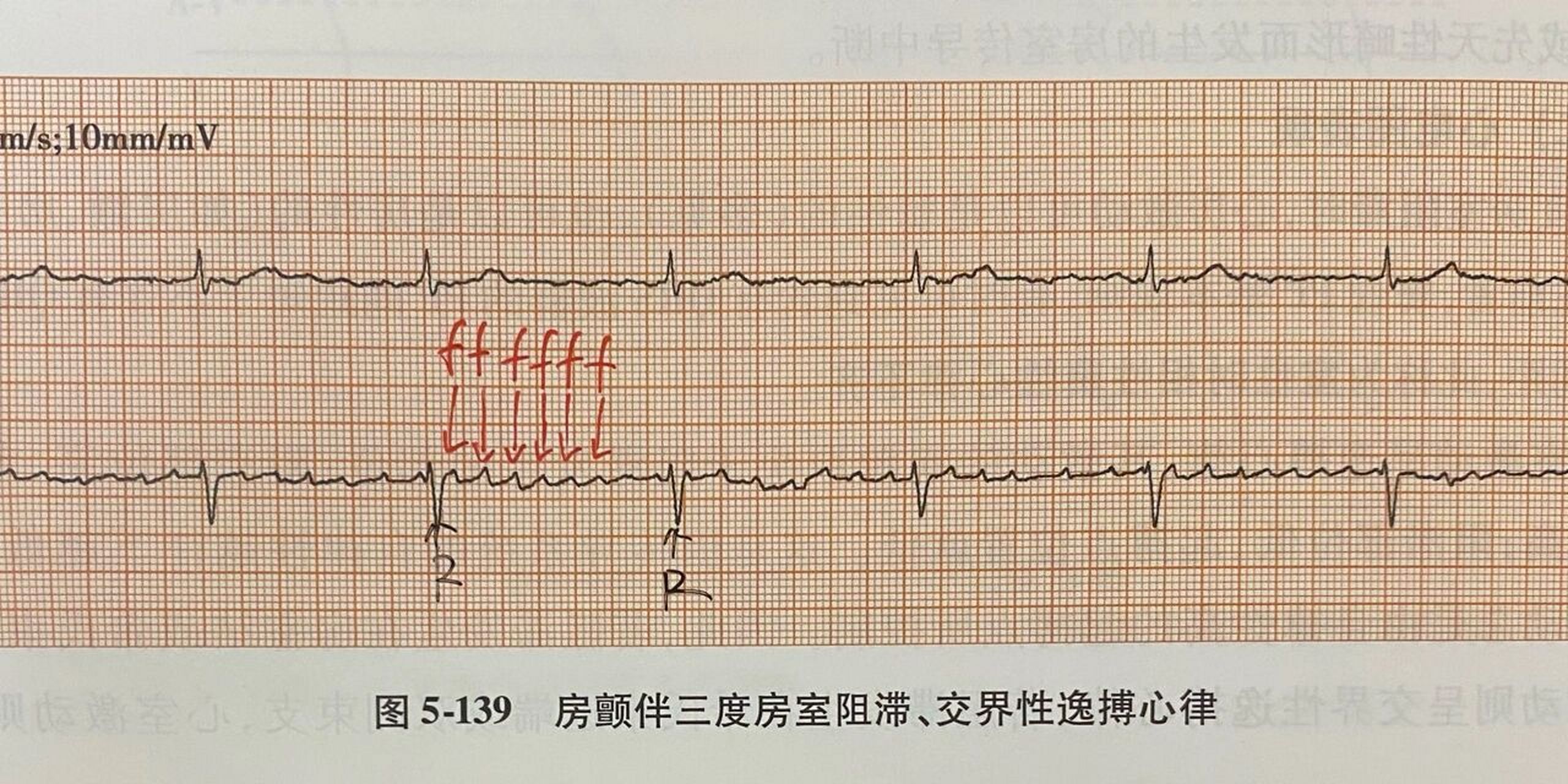 房颤心电图解读图片