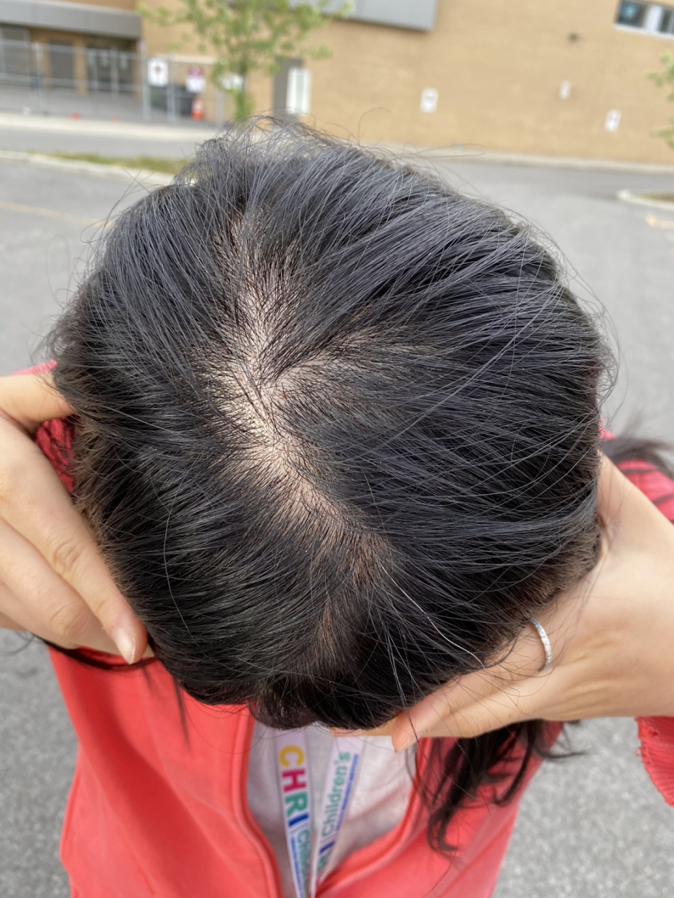 然而我申请博士的时候有焦虑到斑秃一块(硬币大小).