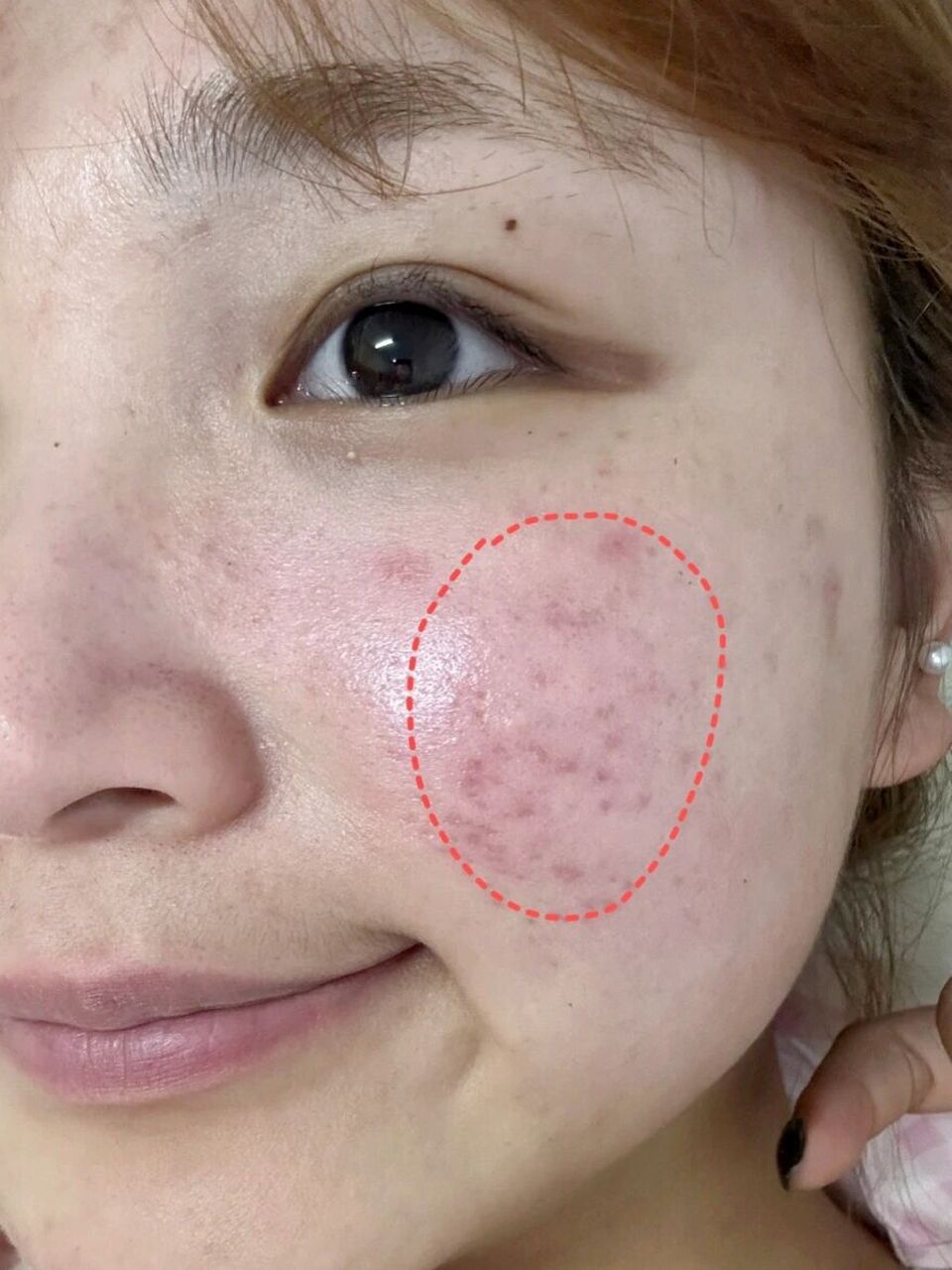 不是智商税,这玩意去脂溢性皮炎嘎嘎牛!