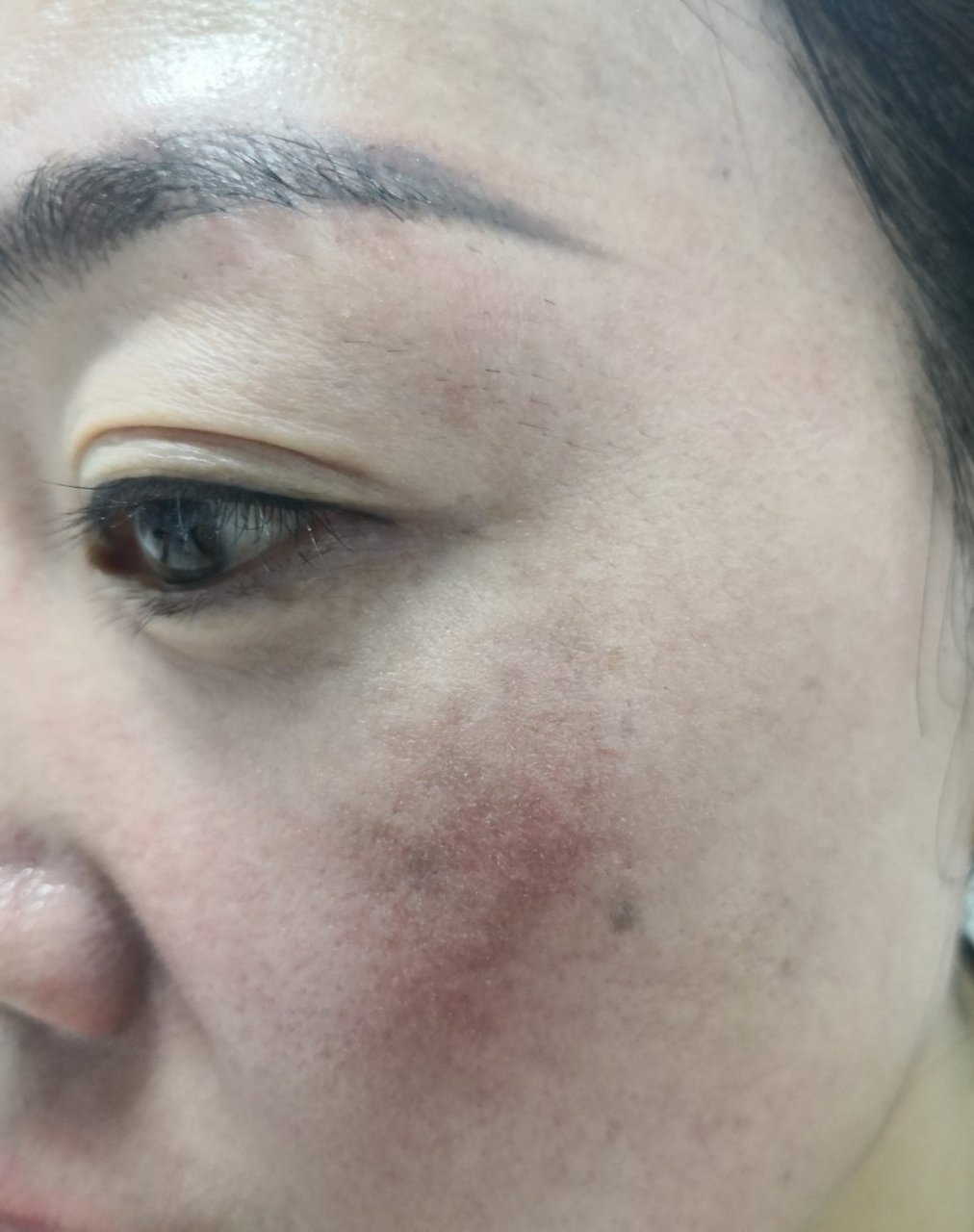 黄褐斑#解决皮肤问题专注皮肤美容