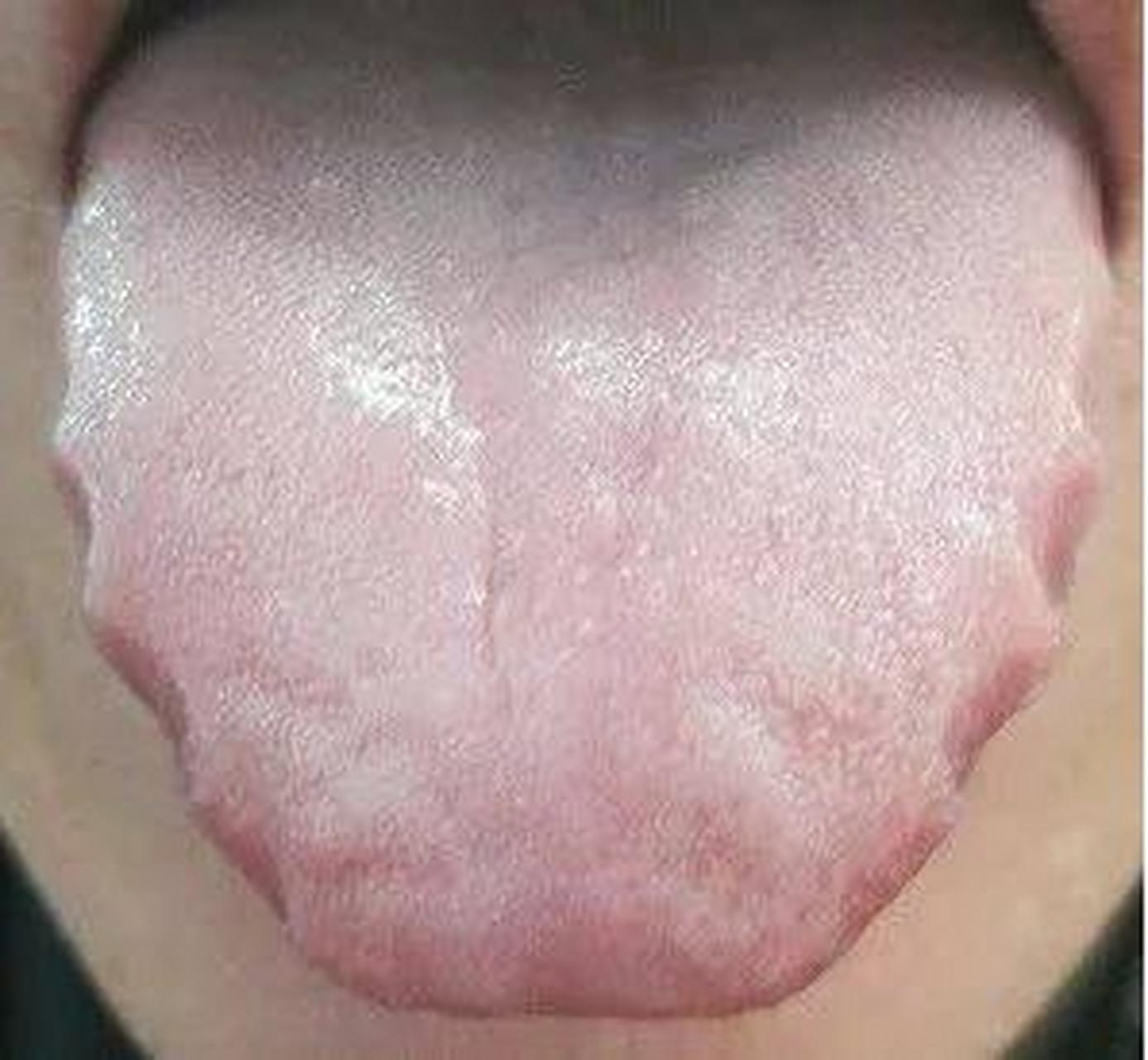 这个小方法看你有没有湿气 如何看舌苔知道你有没有湿气呢?