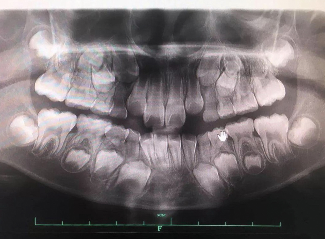 婴儿牙齿拍片图片