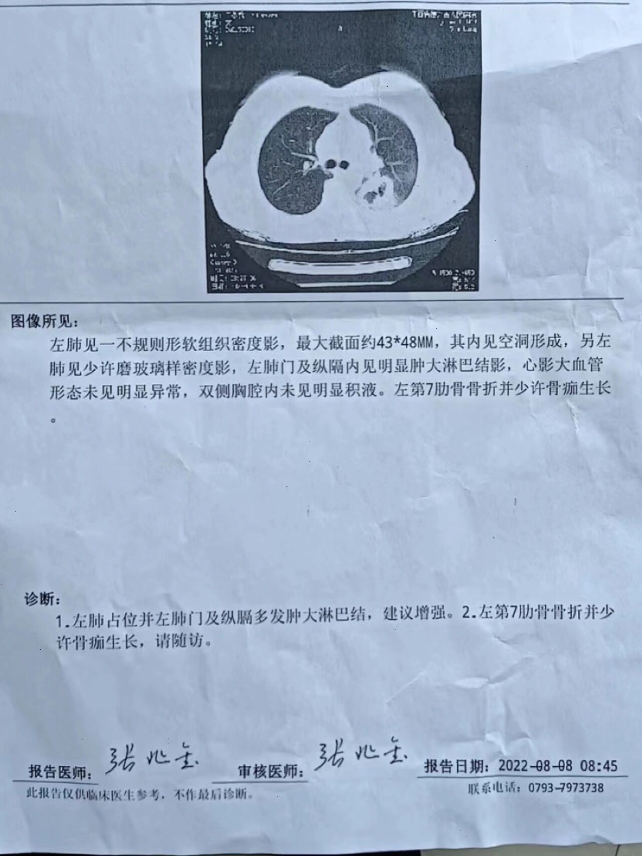 肺癌单子图片图片