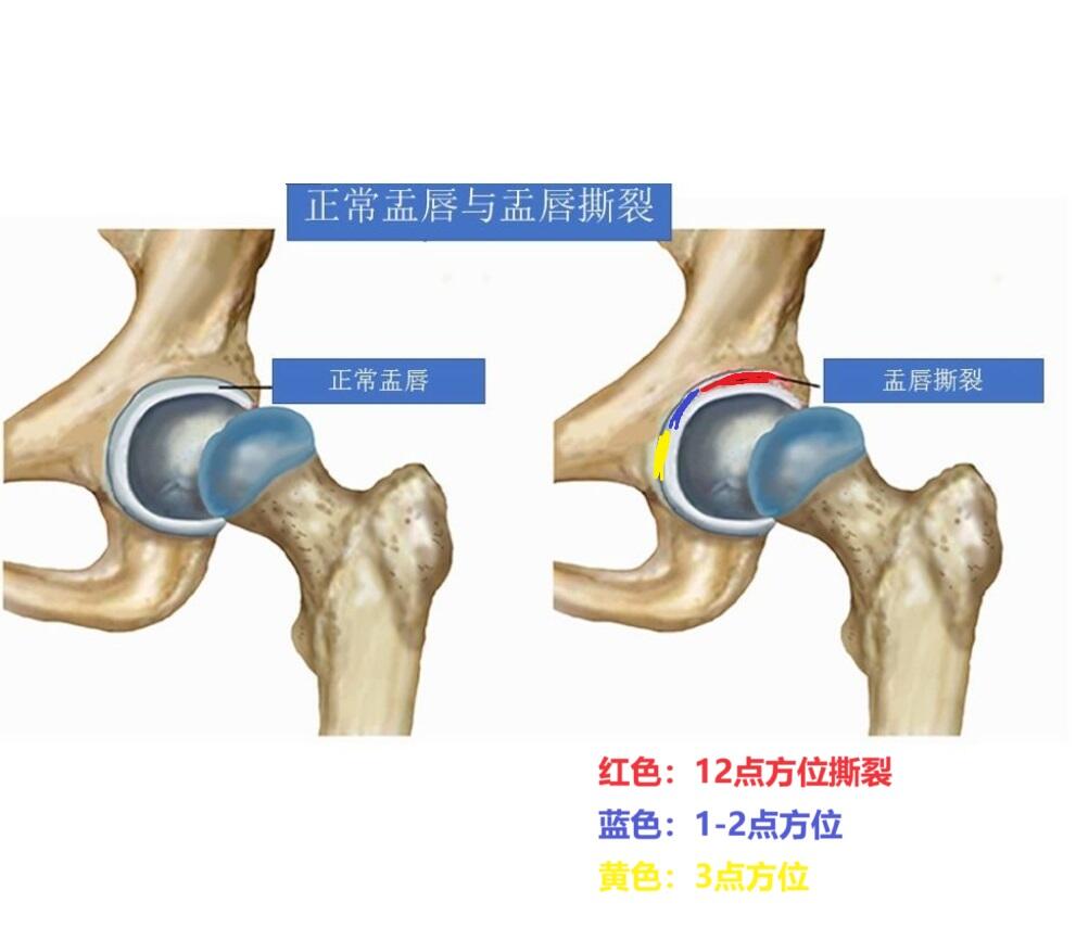 髋关节盂唇解剖图图片