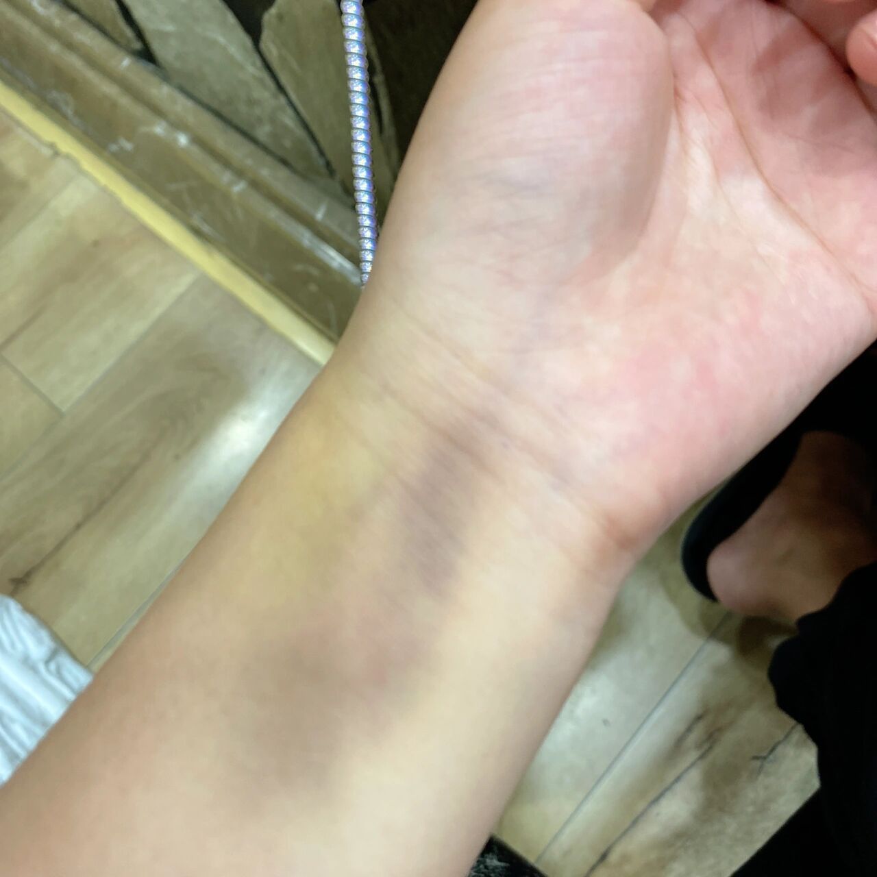 抽血淤青 主要是抽血那块没有淤青旁边全青了