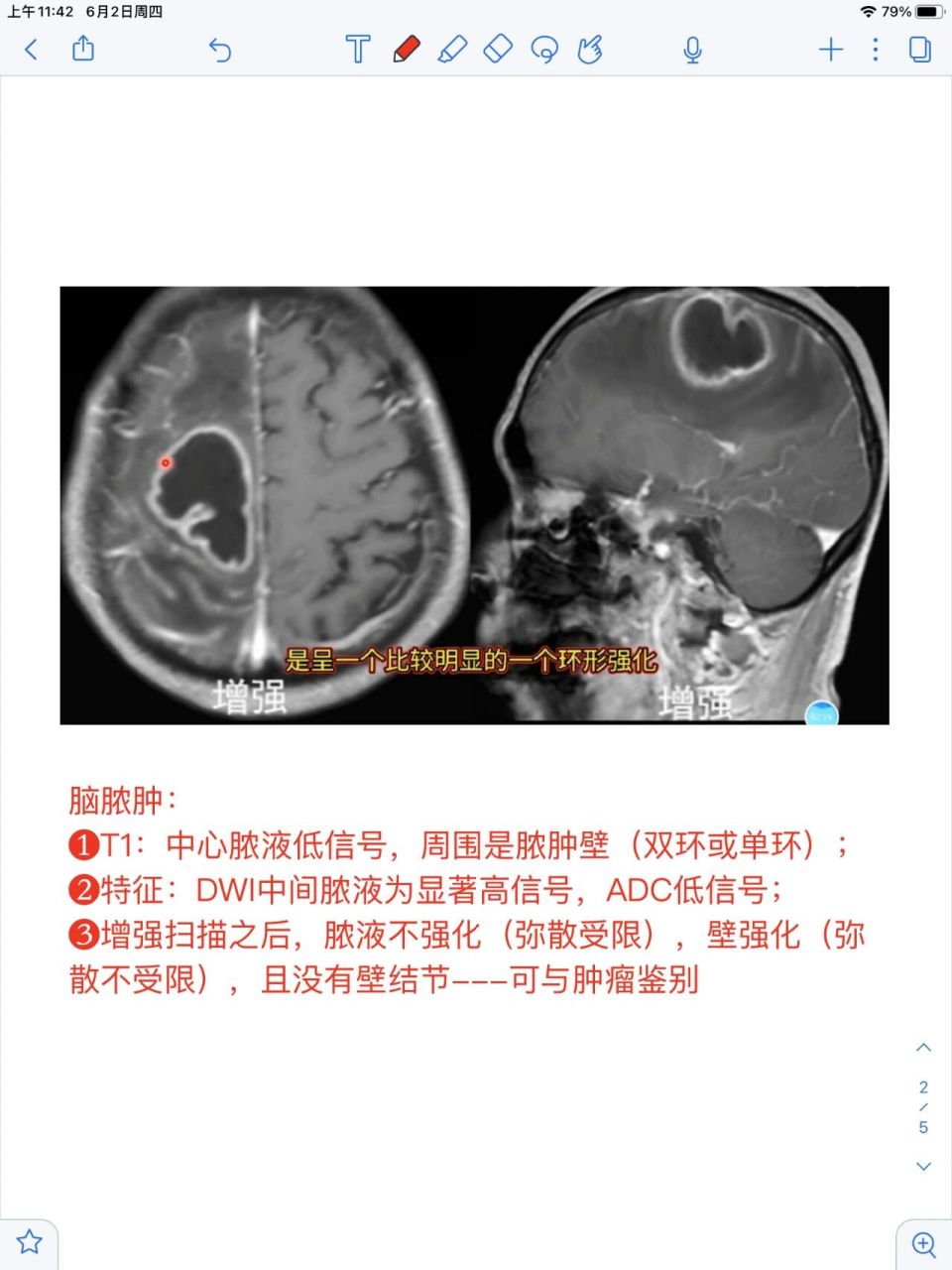 脑脓肿的影像学表现