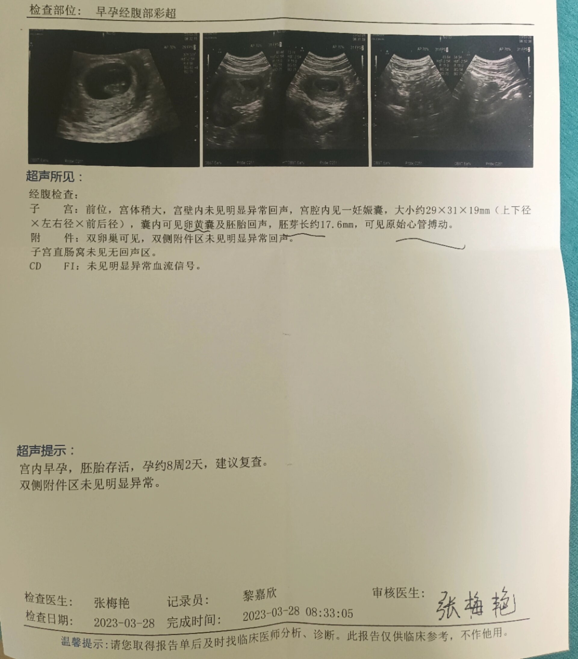 子宫憩室孕8周啦