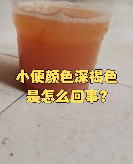 小便颜色深褐色可能有多种原因,常见的有饮食,脱水,药物副作用,也