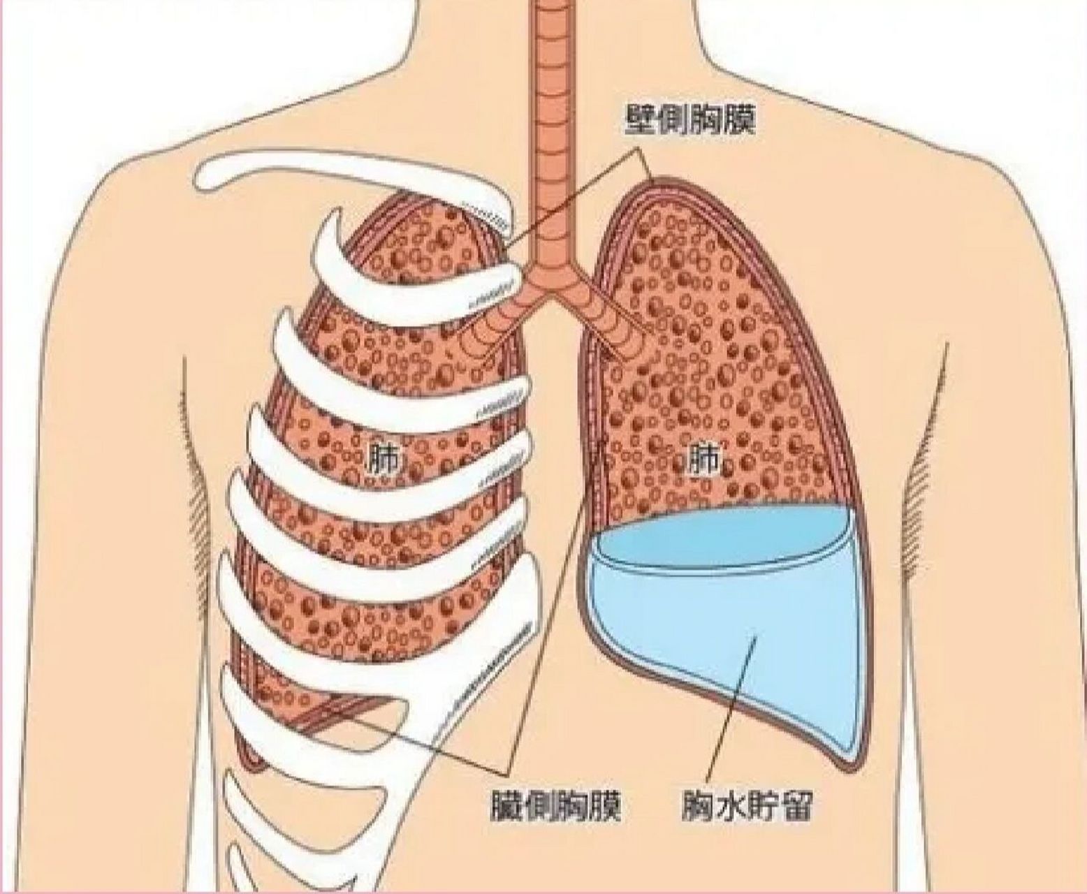 胸腔积液示意图图片