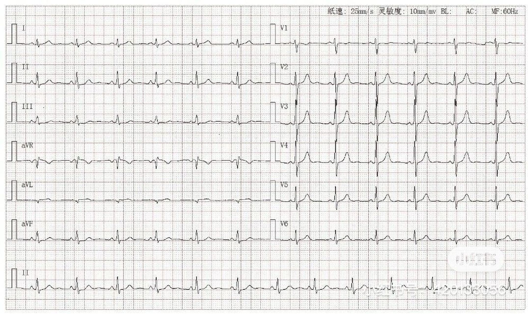 心电图学习|正常心电图是怎样的? 接上篇 3.