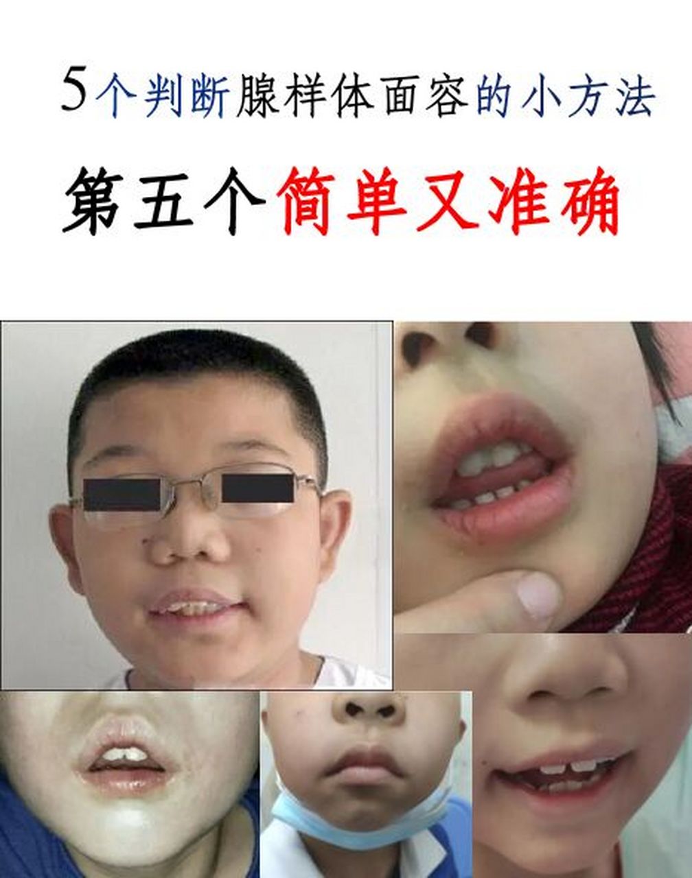 5招判断孩子腺样体面容,第5招省时又省力 今天教给大家5个小方法,判断