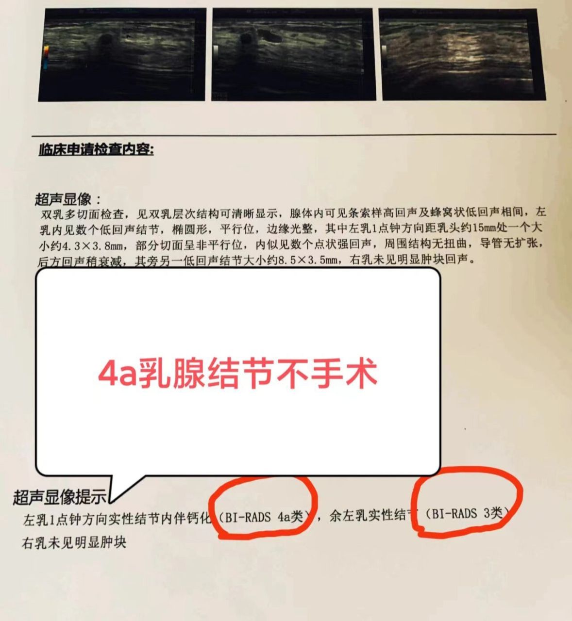 乳腺结节4a必须要做手术吗乳腺结节4a,你还可以试试中医治疗,不一定