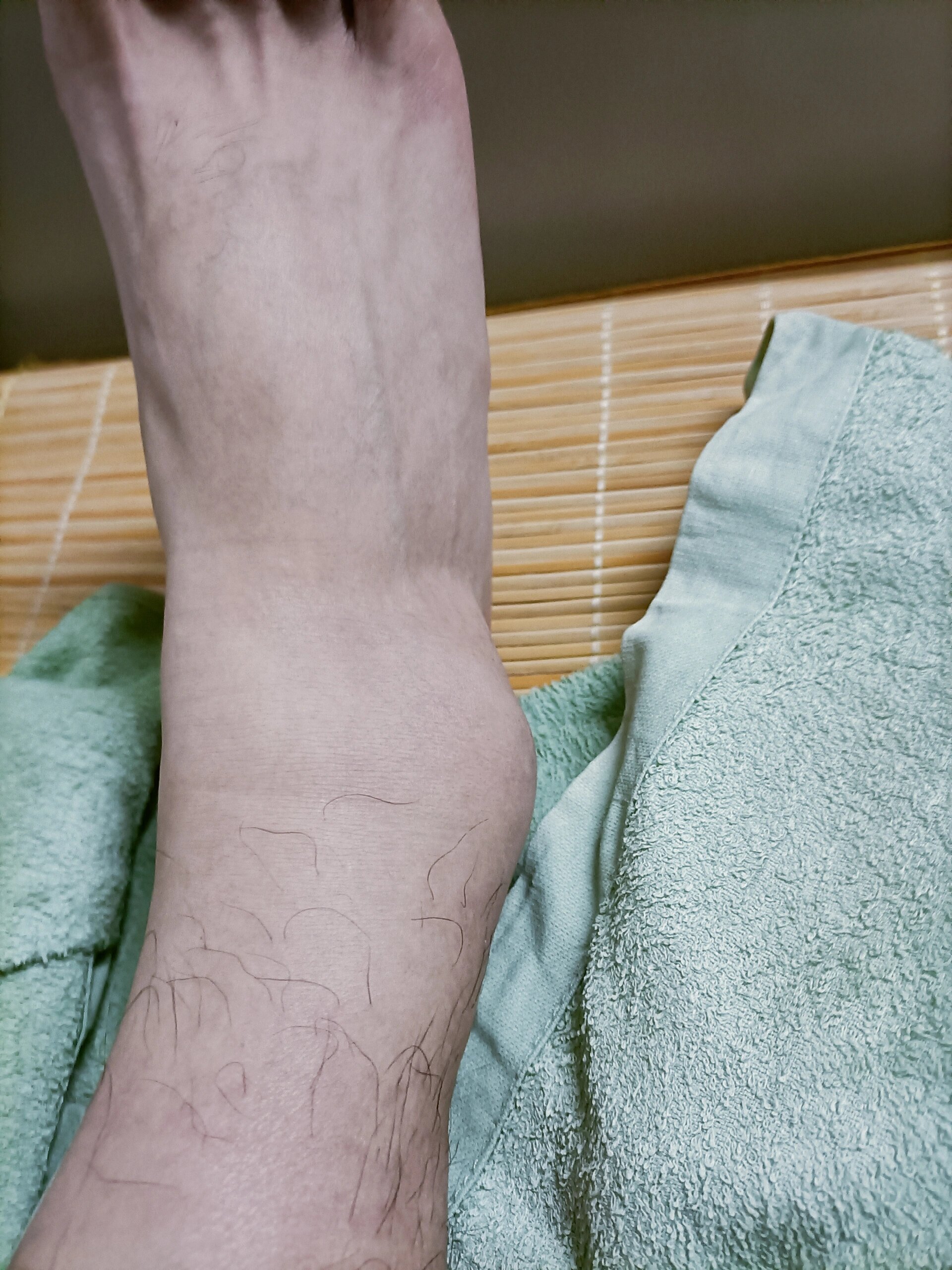 崴脚 肿胀 积血