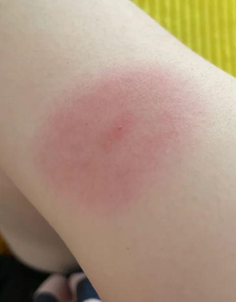 被虫子咬了后留下红色的硬块,这通常是因为虫子咬人时残留在皮肤内