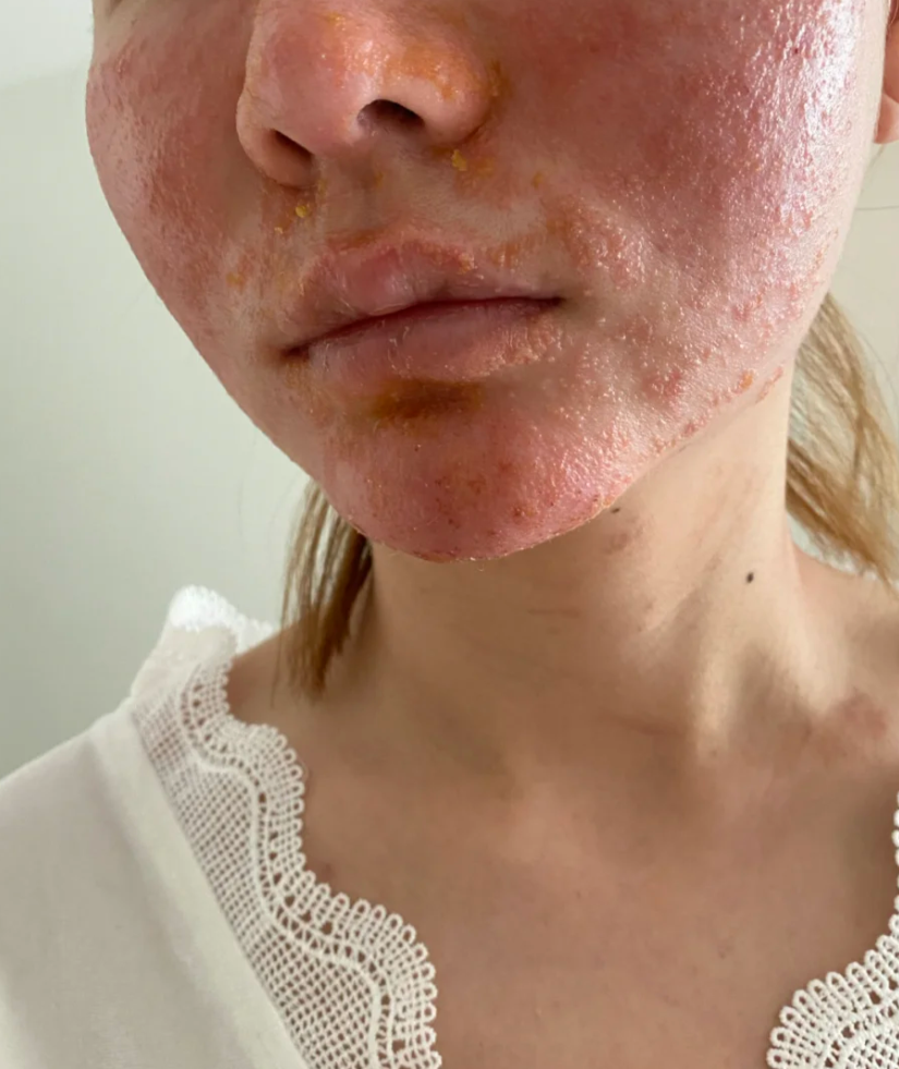 皮肤过敏能不能游泳要看具体情况