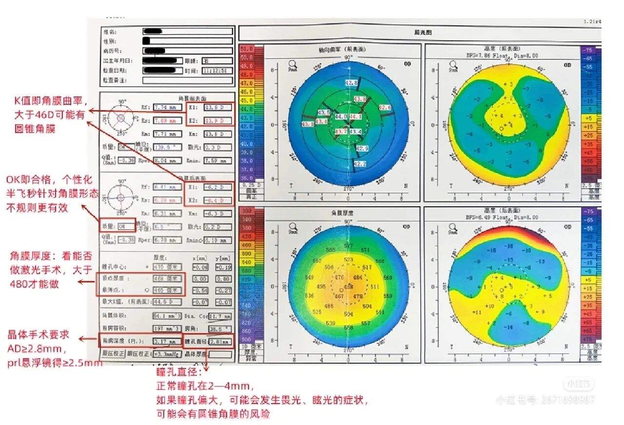 角膜地形图的作用图片