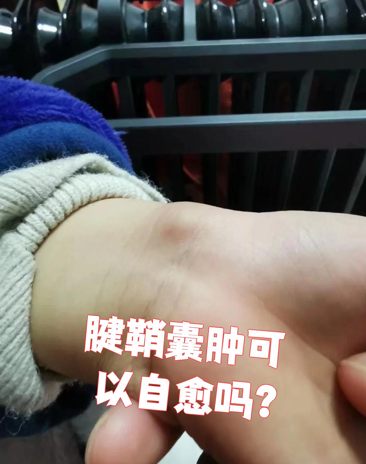 腱鞘囊肿是有可能自己好的,不用太紧张