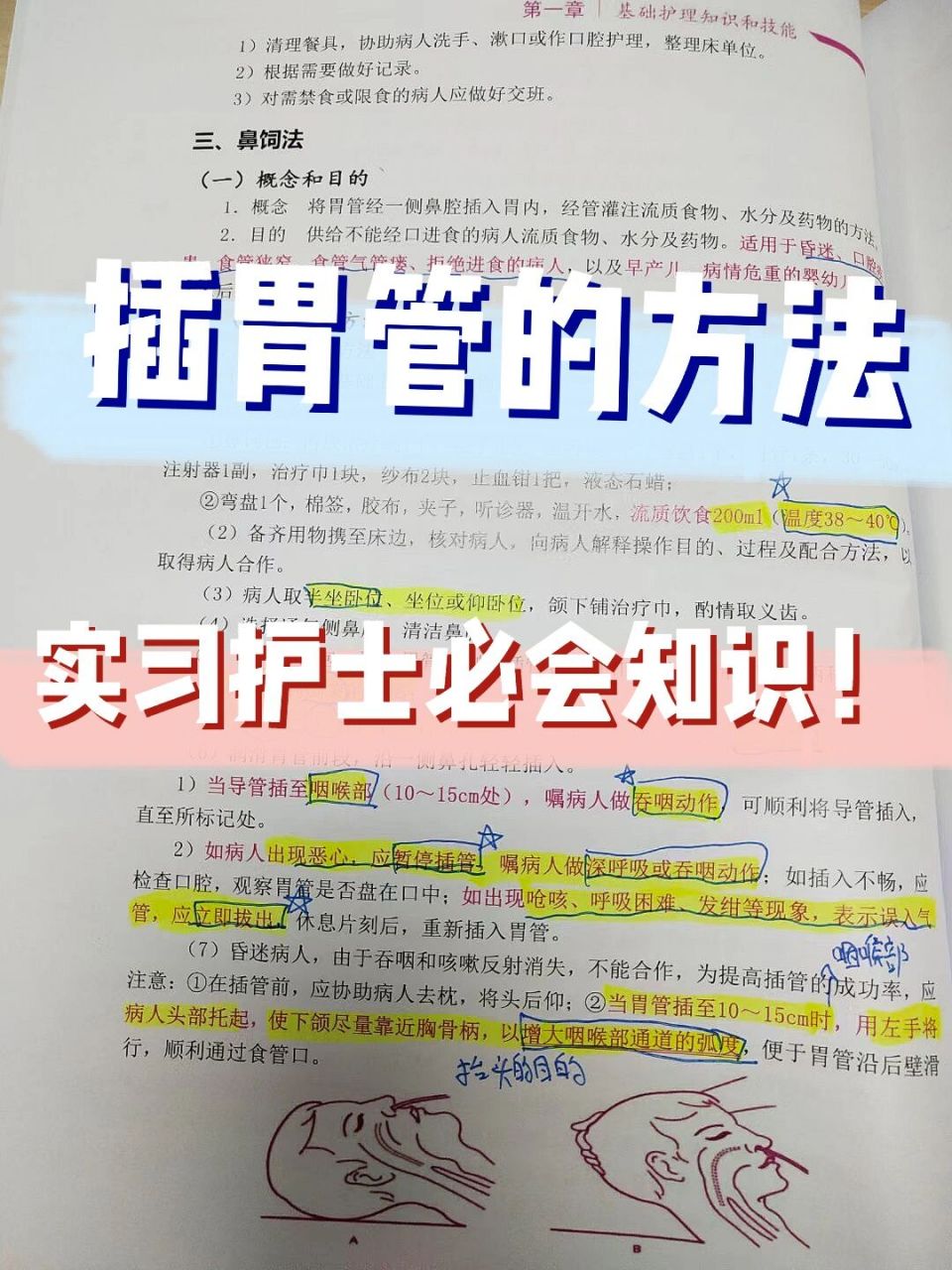 插胃管的方法|实习护士必会知识!